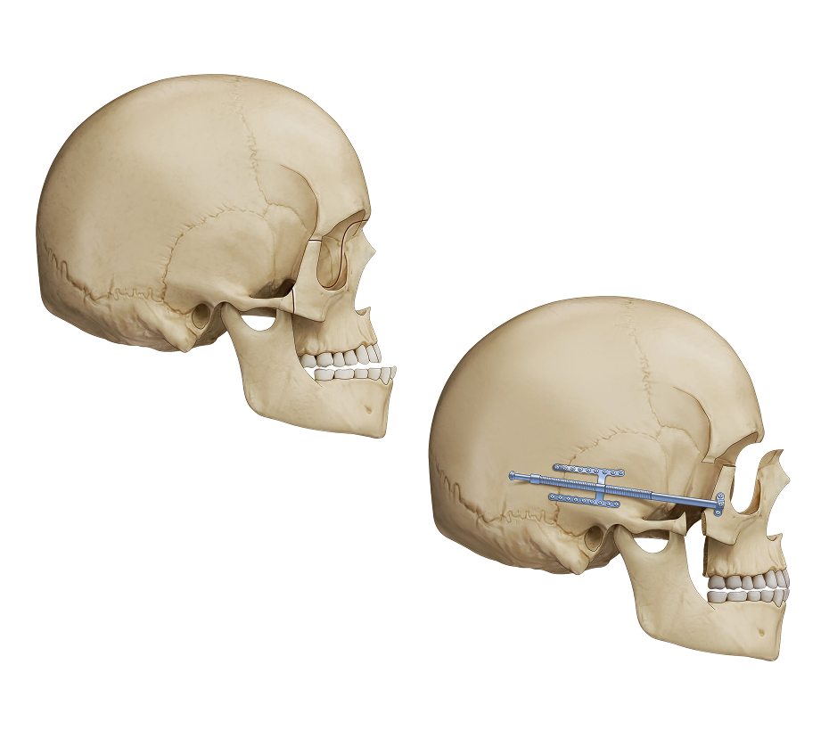 Le Fort III Osteotomy Distraction Illustration (3)