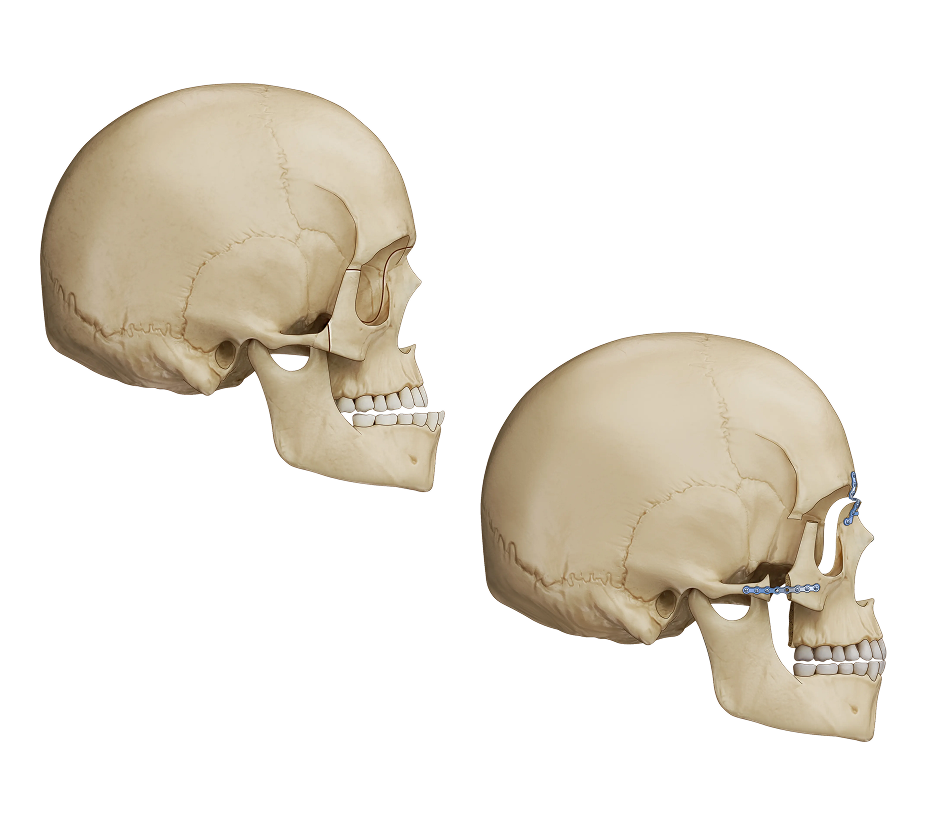 Le Fort III Osteotomy Illustration (2)