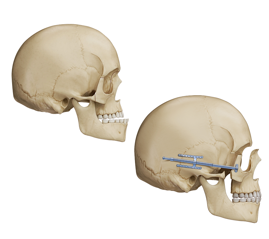 Illustration of Le Fort III surgery repositioning the midface.