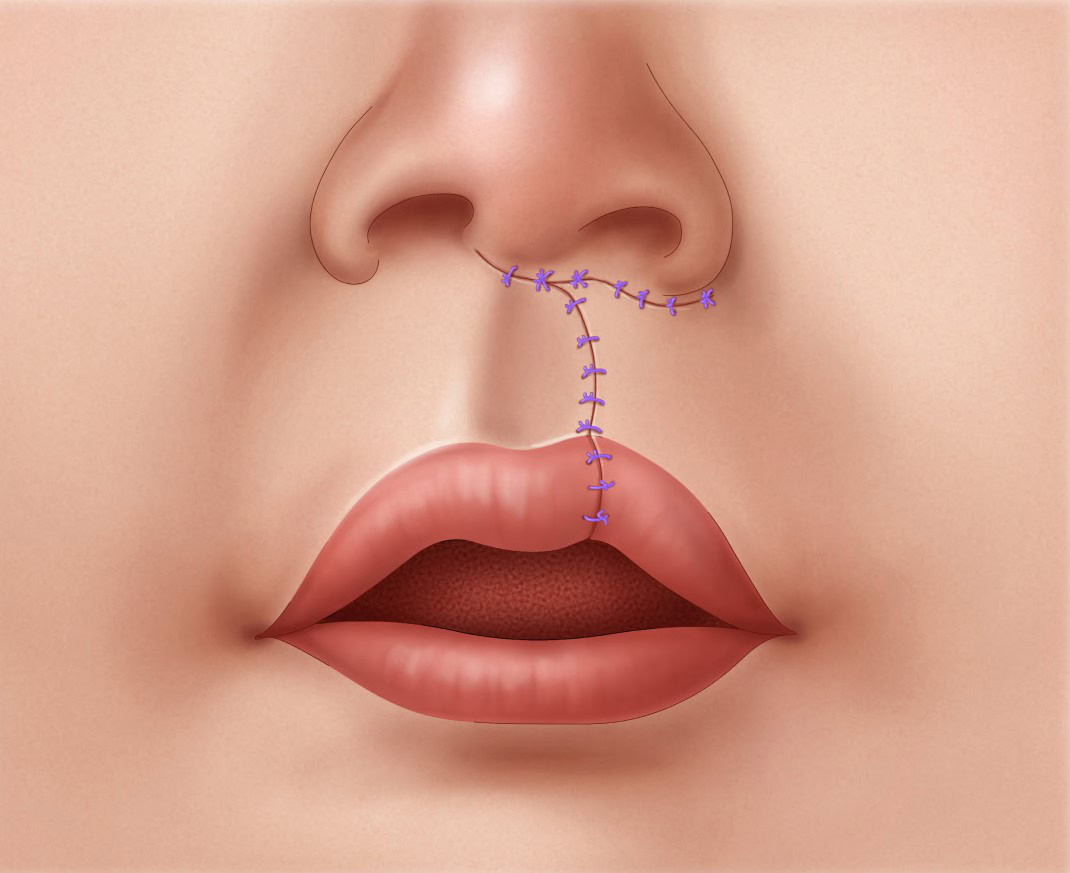 Unilateral-Cleft-Lip-Repair-step-3-3xv2 Illustration of the lip segments brought together and sutured in unilateral cleft lip repair.