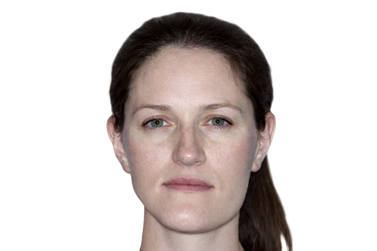 Mandibular-Asymmetry-frontal-3 Clinical presentation of mandibular asymmetry, frontal view.
