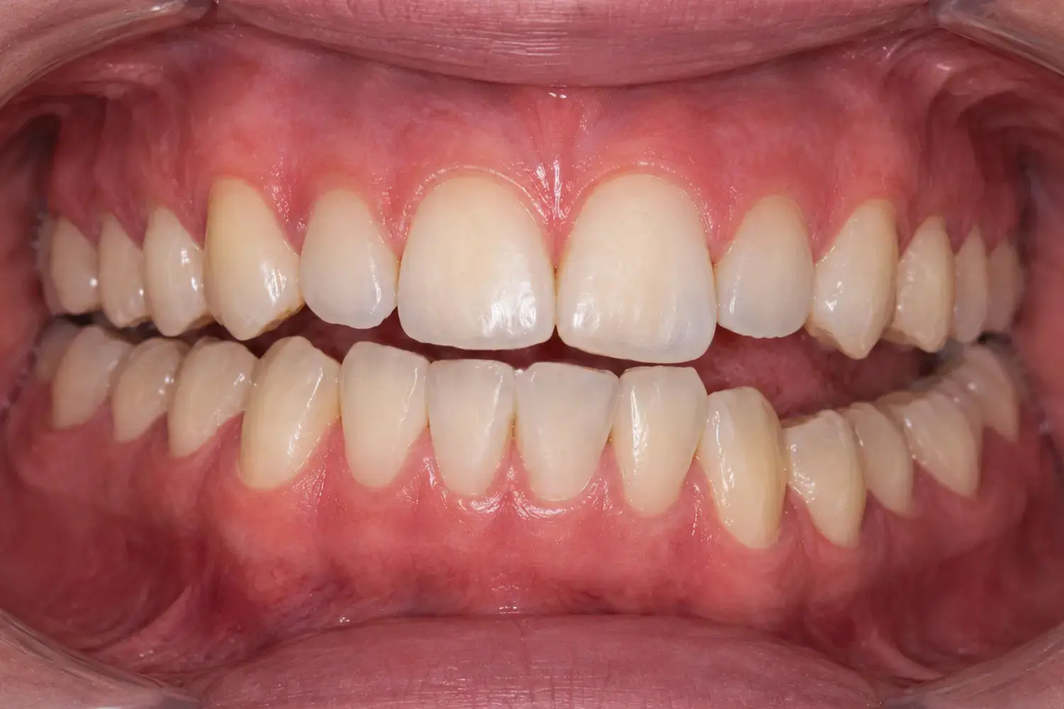 mandibular-asymmetry-occlusal view 4 Clinical presentation of mandibular asymmetry, occlusal view.