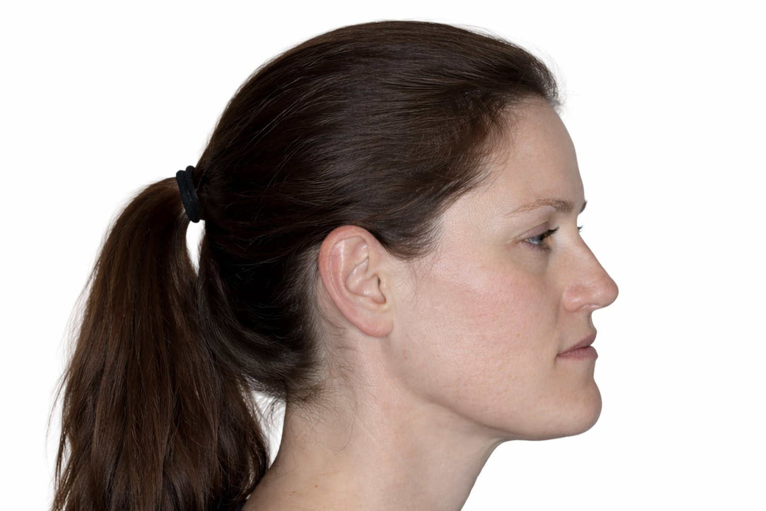 Mandibular-Asymmetry-profile-2 Clinical presentation of mandibular asymmetry, profile view.