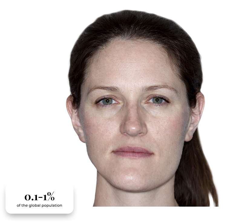 Close-up of woman's face showing mandibular asymmetry.