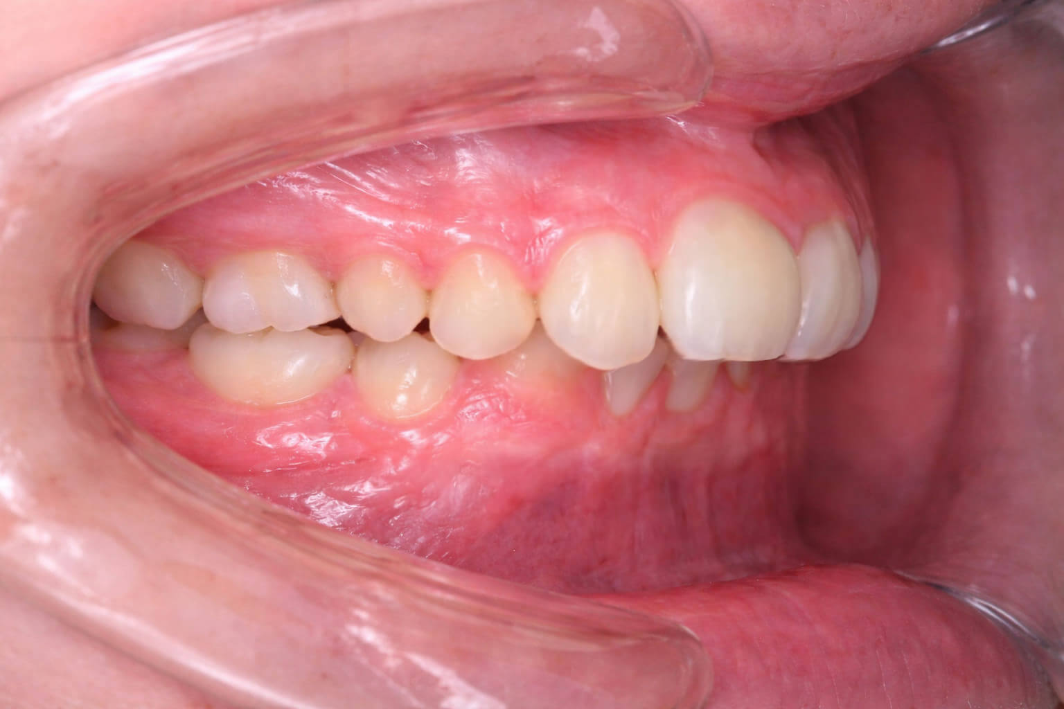 mandibular-retrognathia-occlusal-2 Clinical presentation of mandibular retrognathia, occlusal view.
