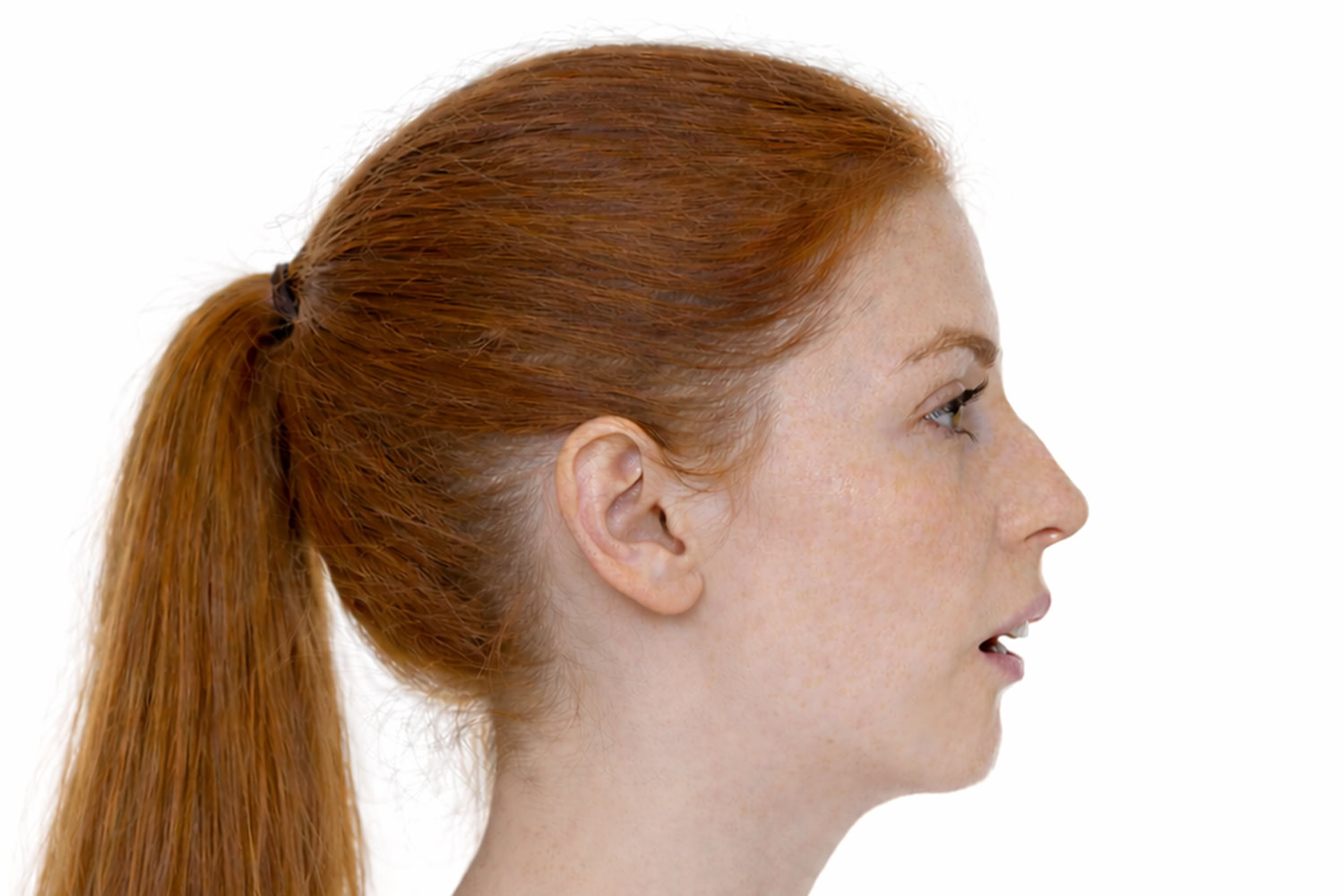 mandibular-retrognathia-profile 1 Clinical presentation of mandibular retrognathia, profile view.
