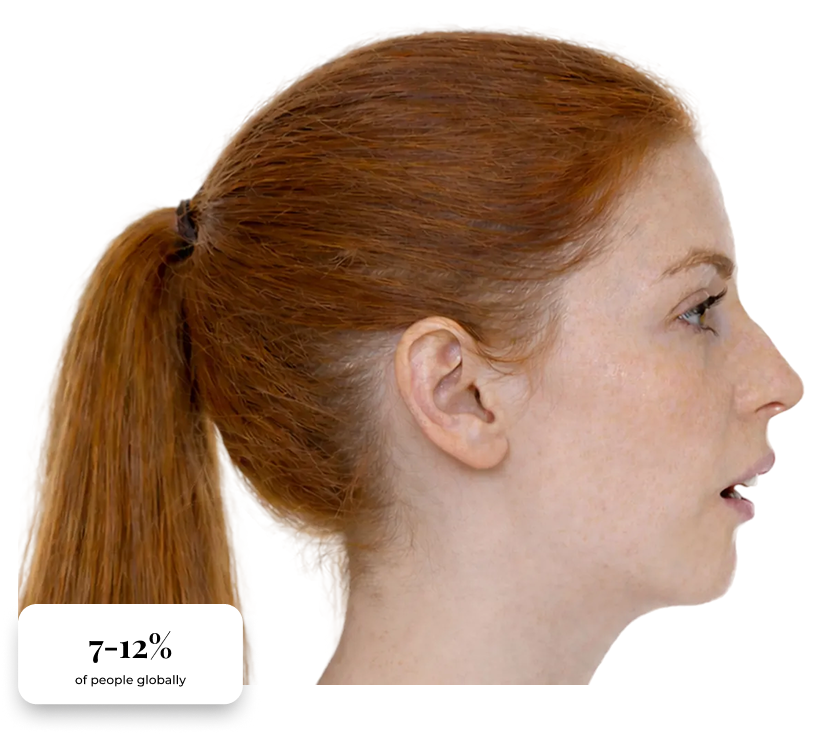 Clinical presentation of mandibular retrognathia, with statistics.