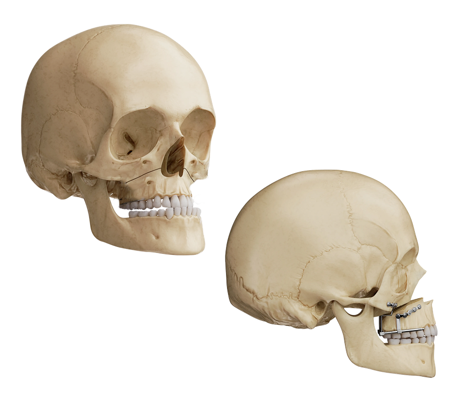 Illustration of maxillary distraction advancing the upper jaw with a controlled device.