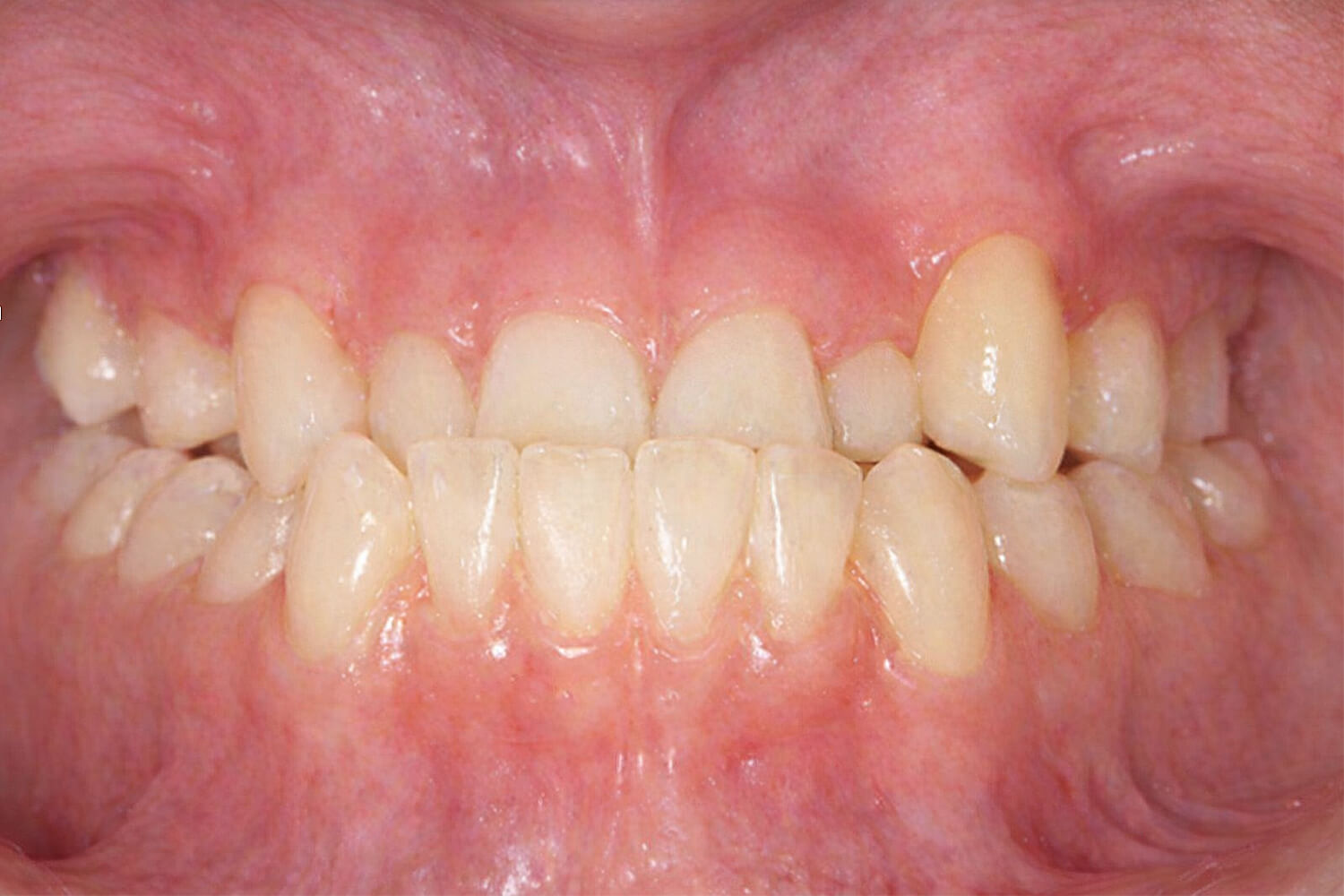 Maxillary-Retrognathia-occlusal Clinical presentation of maxillary hypoplasia, occlusal view.