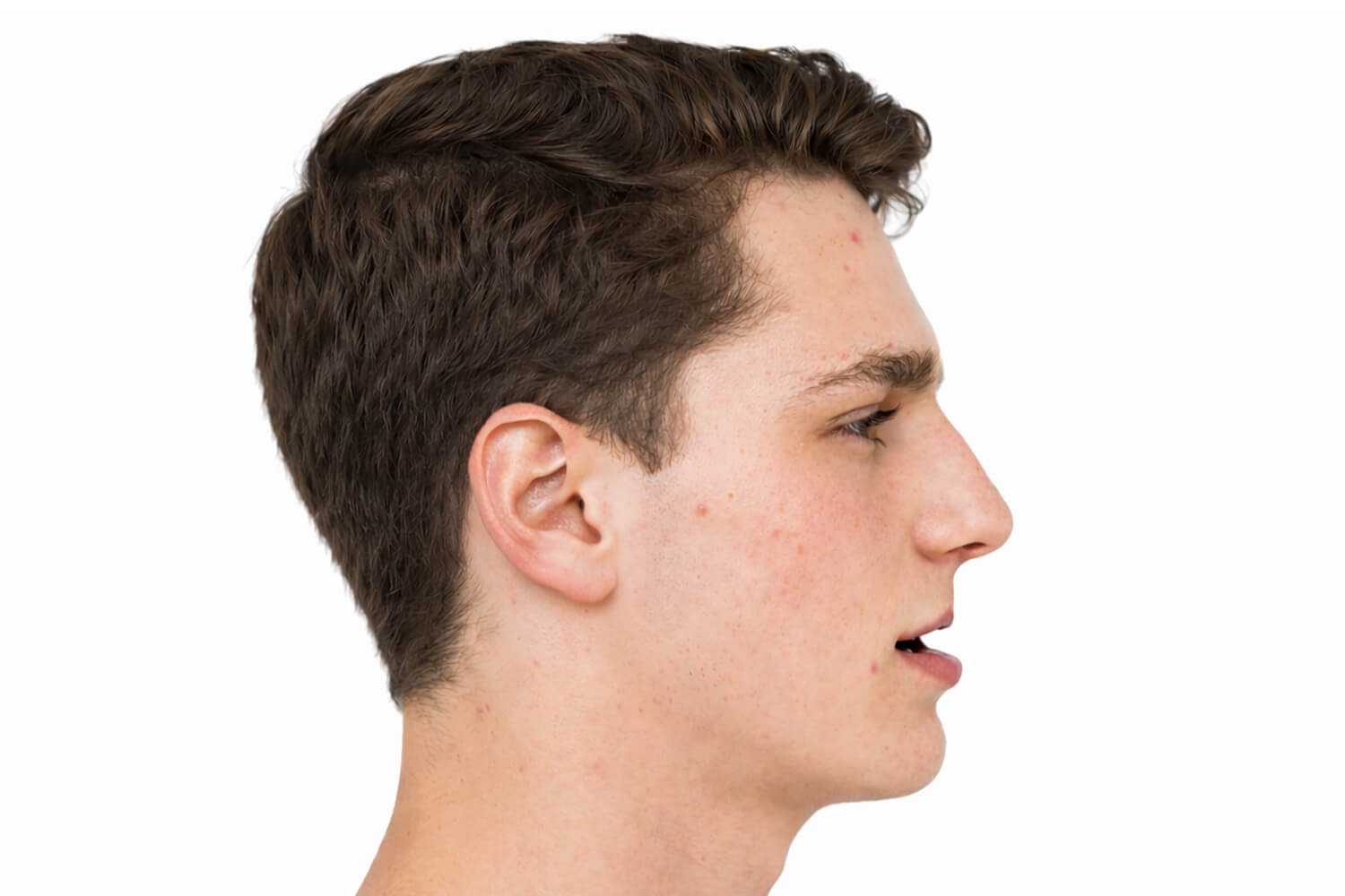 Maxillary-Retrognathia-profile-scaled Clinical presentation of maxillary retrognathia, profile view.