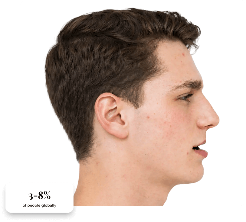 Clinical presentation of maxillary retrognathia, with statistics.