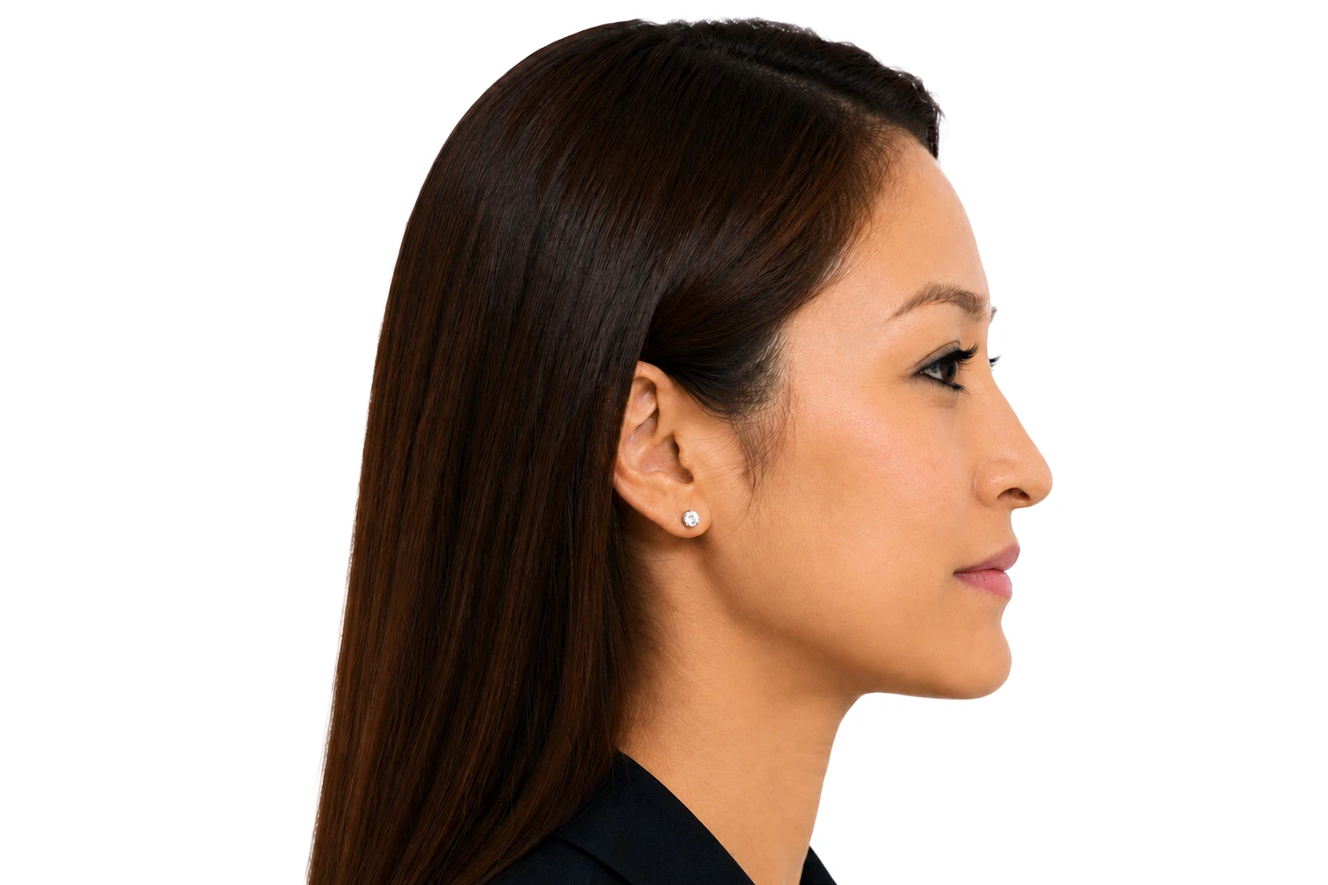 Maxillary-Transverse-Deficiency-profile-2 Clinical presentation of maxillary transverse deficiency, profile view.