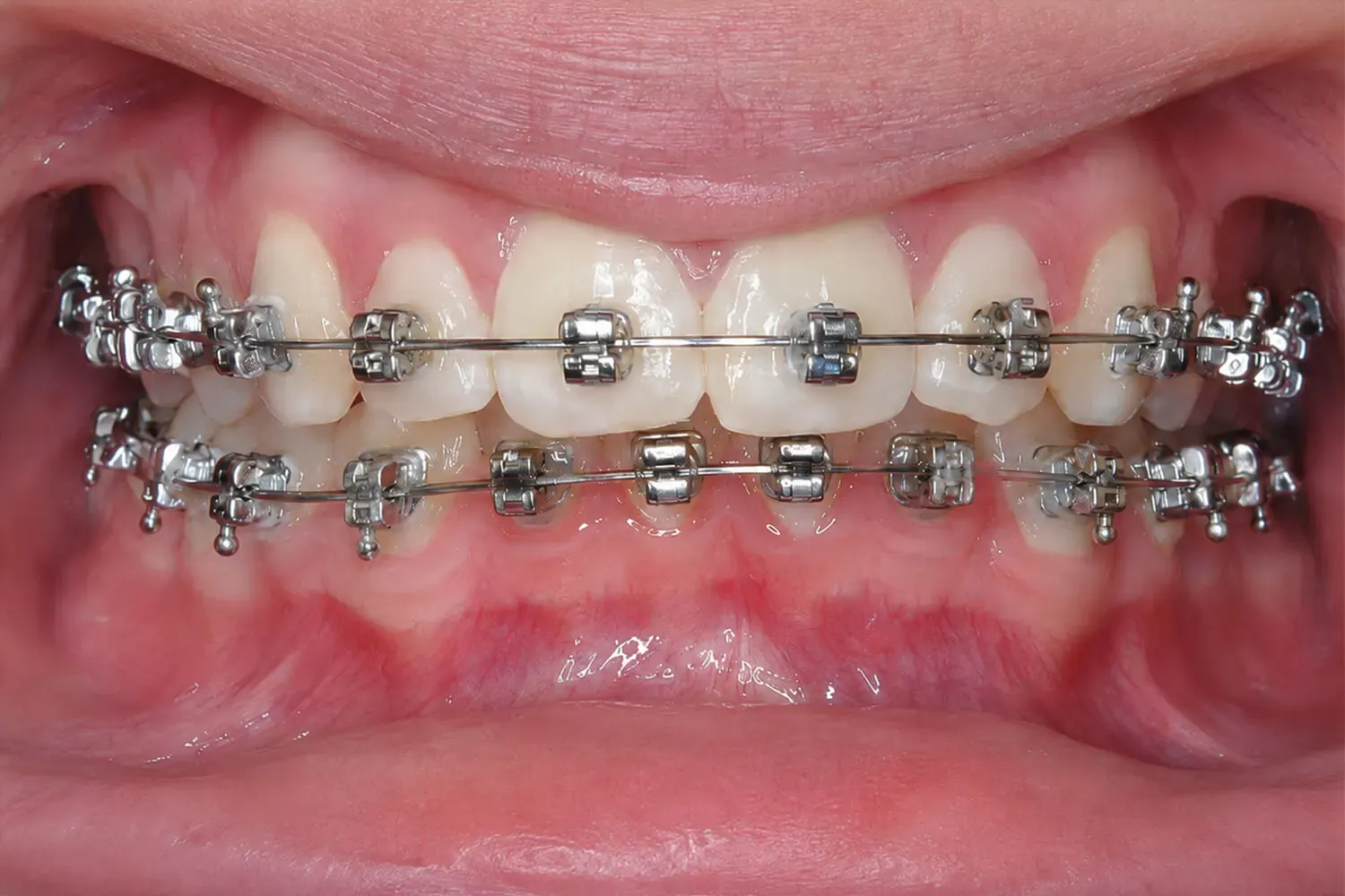 maxillomandibular-deficiency-braces-occlusal-view Occlusal view of dental braces treating maxillomandibular deficiency