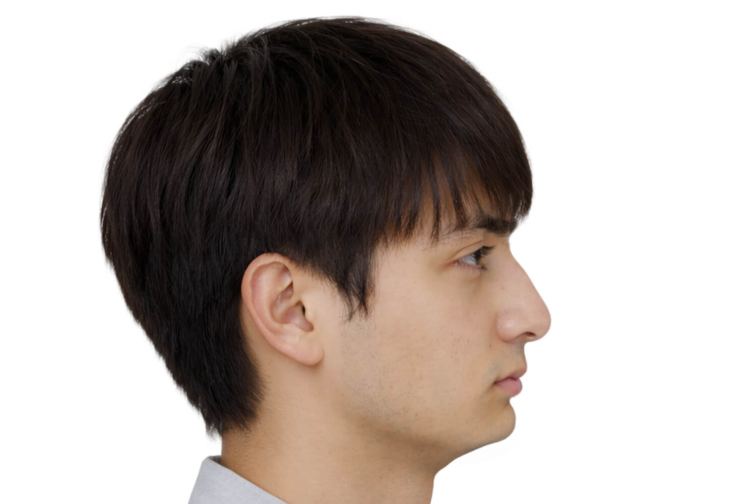 Maxillomandibular-Deficiency-profile-scaled Clinical presentation of maxillomandibular deficiency, profile view.