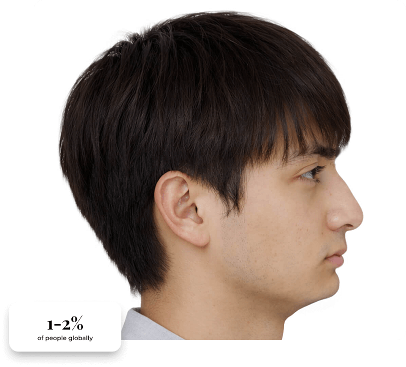 Clinical presentation of maxillomandibular deficiency, with statistics.