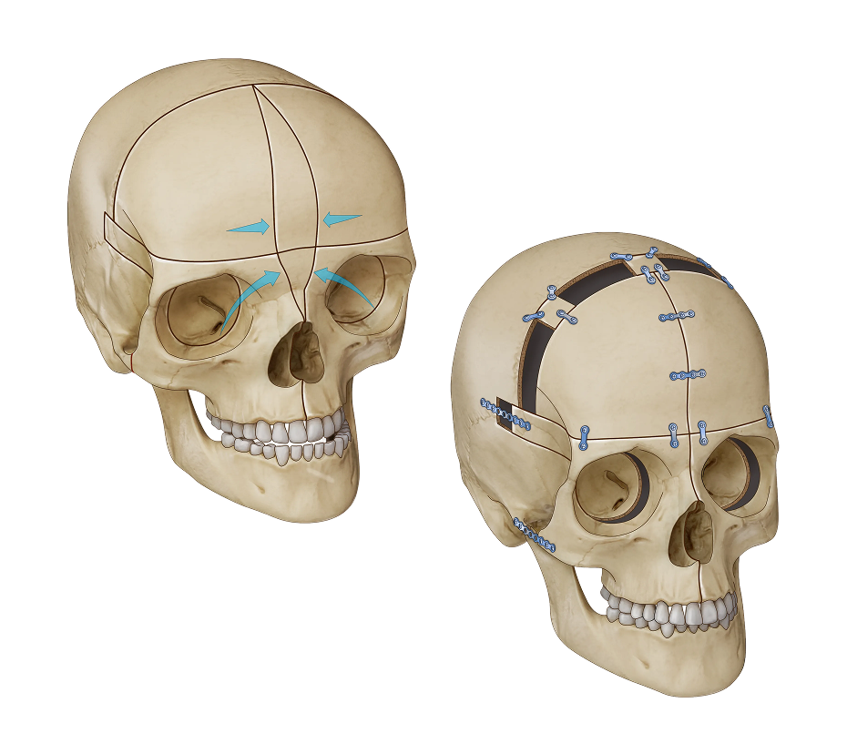 Monobloc Facial Bipartition Illustration