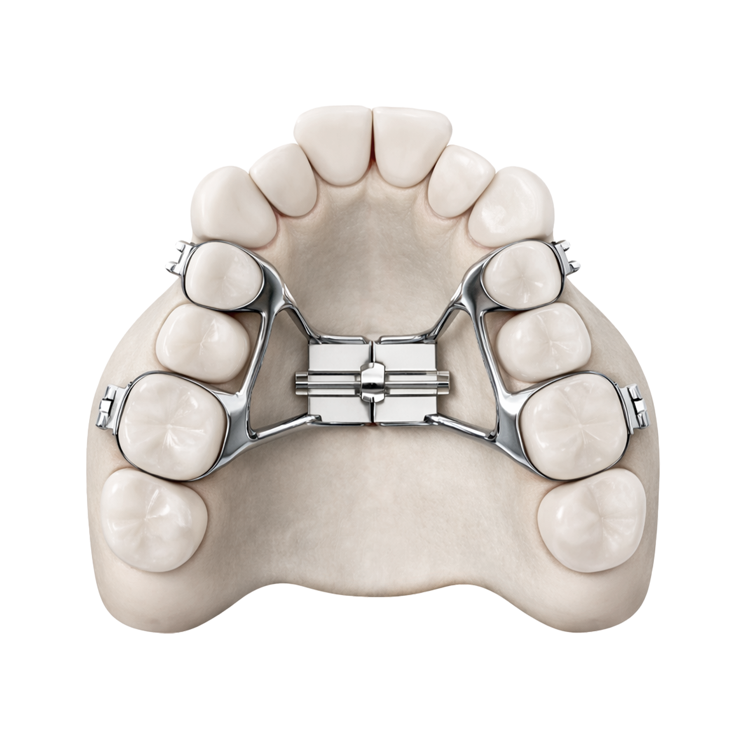 SARPE - before Illustration of a narrow upper jaw before surgically assisted rapid palatal expansion.