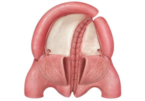 bardach 4 - reframed - wide Illustration of the nasal lining sutured closed during Bardach palatoplasty.