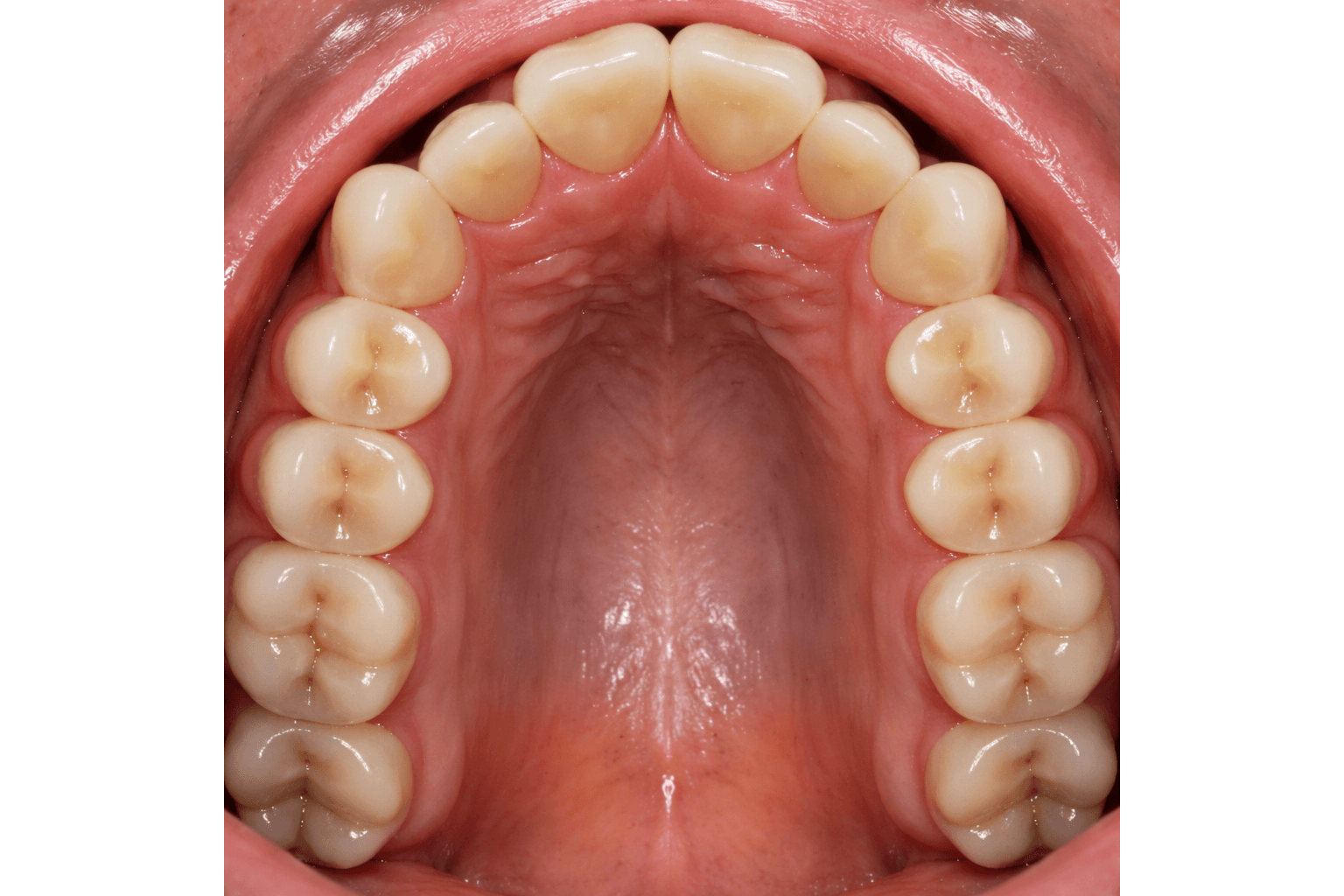occlusal_3x2_no_crop-scaled Occlusal View maxillary transverse constriction.