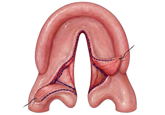 cleft palate step 2 Opposing Z-plasty flaps raised- Furlow Palatoplasty
