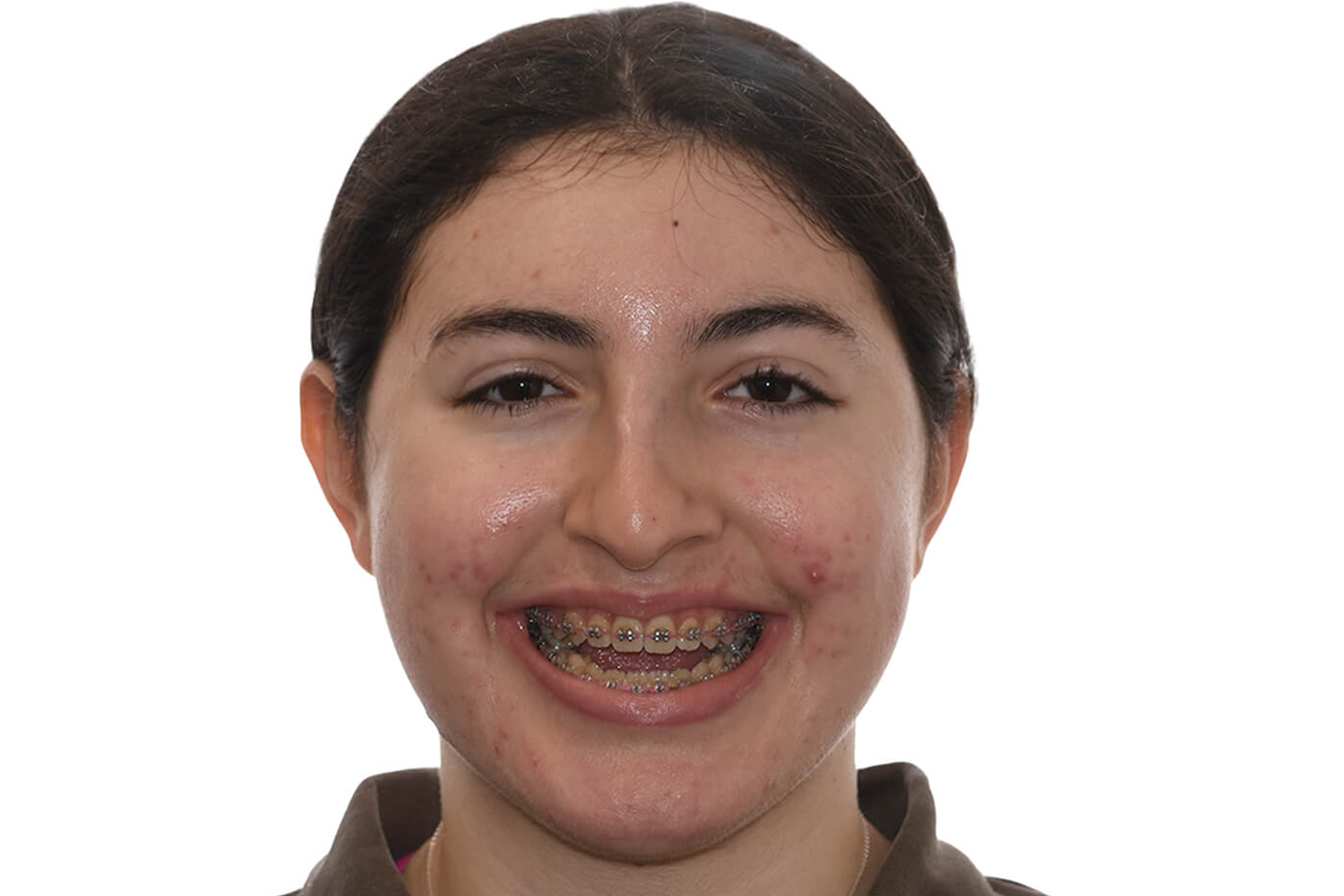 Profile Before Anterior Open Bite Surgery at the Jaw Surgery Center of New Jersey.