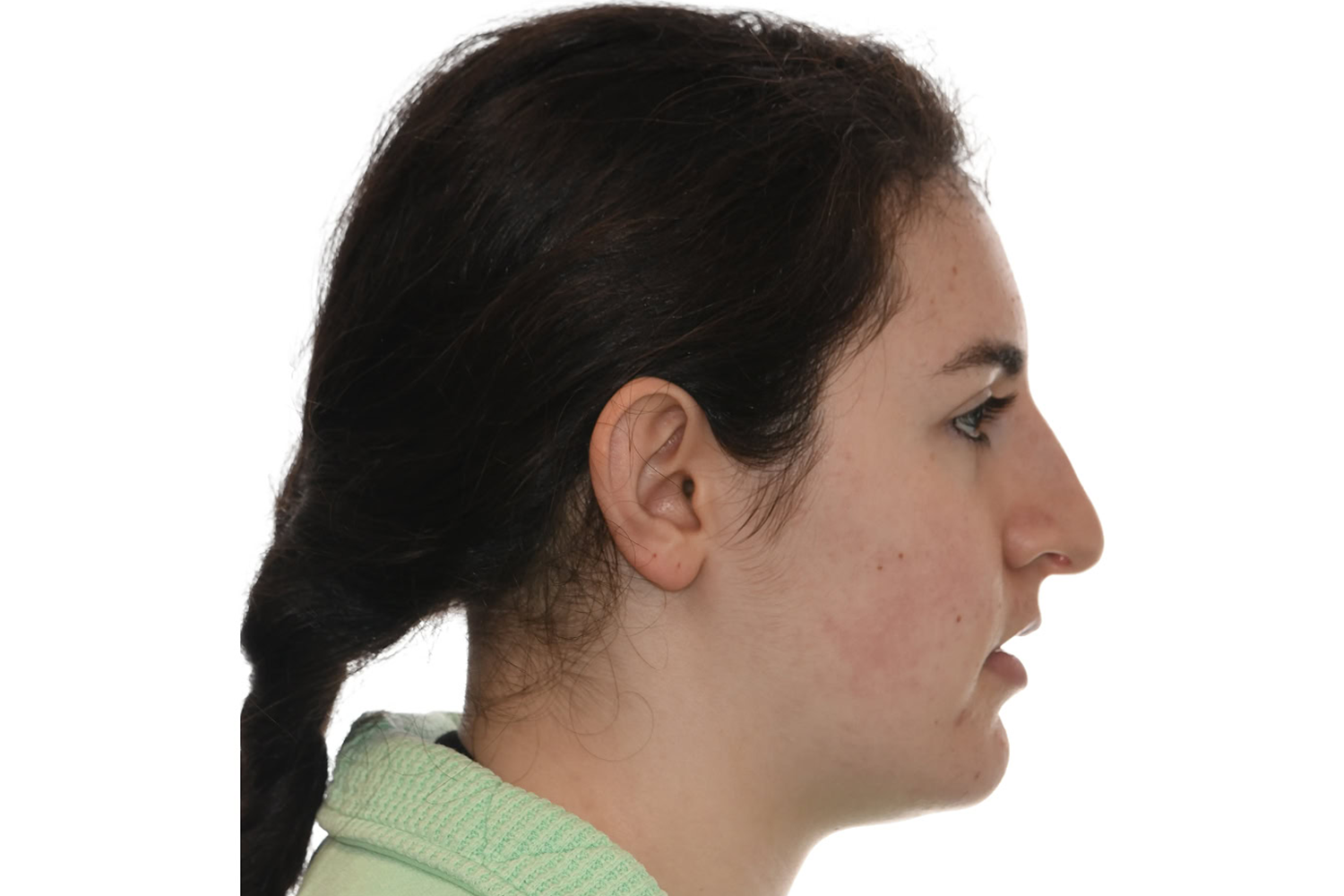 Profile After Surgery of a patient treated for anterior open bite with orthognathic surgery at the Jaw Surgery Center of New Jersey.