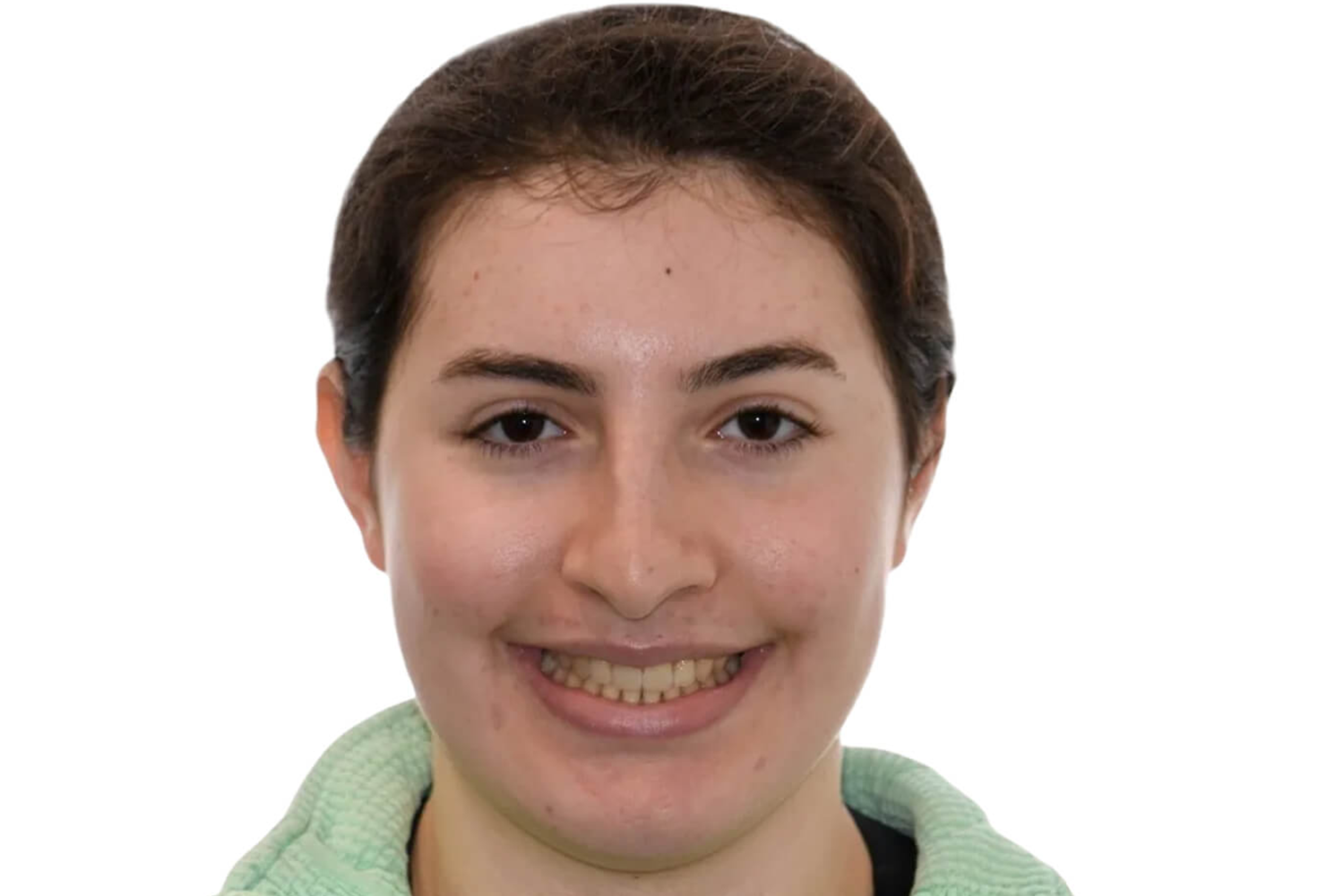 Frontal View After Anterior Open Bite Surgery at the Jaw Surgery Center of New Jersey.