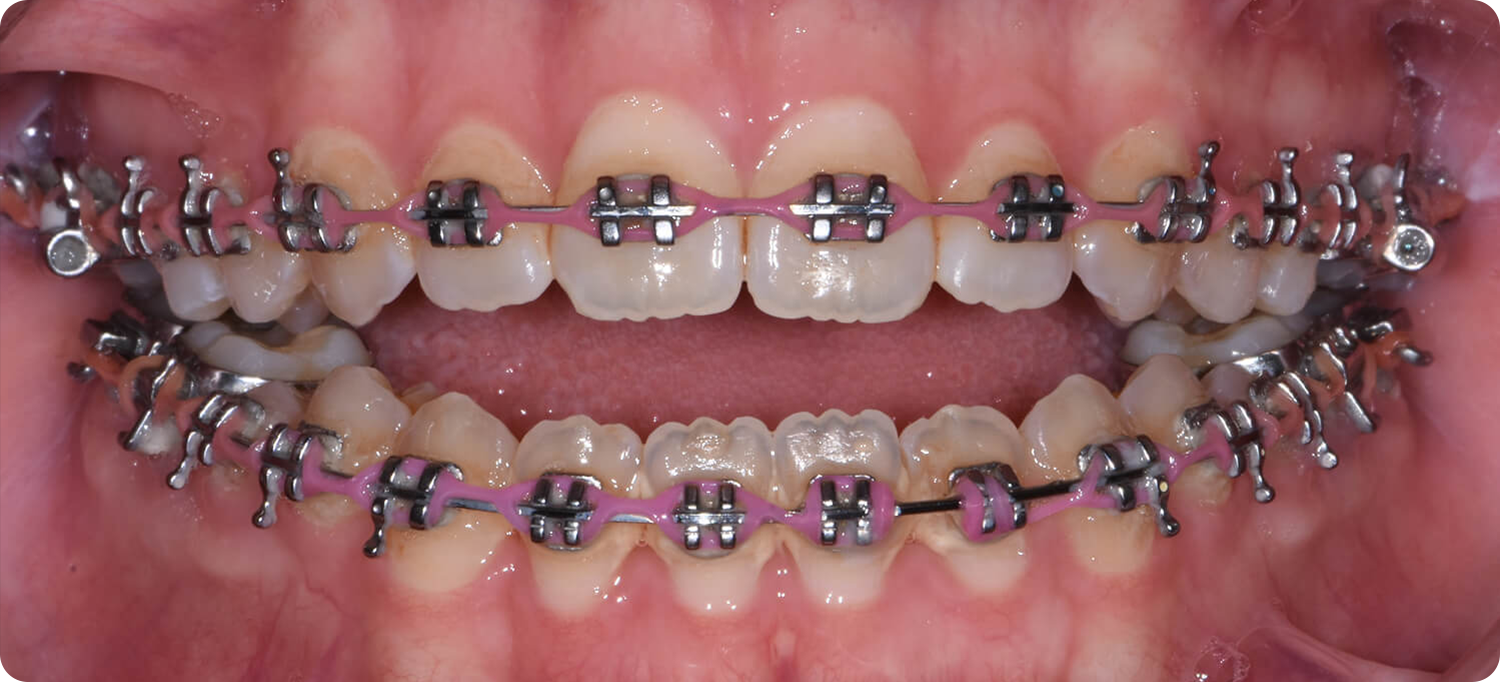 Occlusal View Before Surgery of a patient with Anterior Open Bite treated with orthognathic surgery at the Jaw Surgery Center of New Jersey.