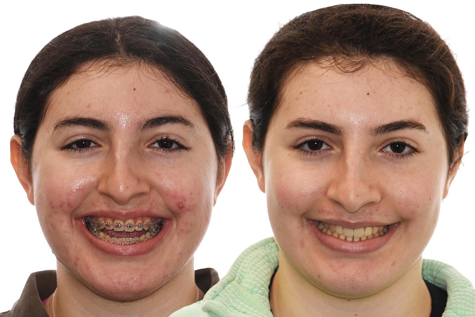 Before and After Comparison of a patient treated with orthognathic surgery for anterior open bite at the Jaw Surgery Center of New Jersey.