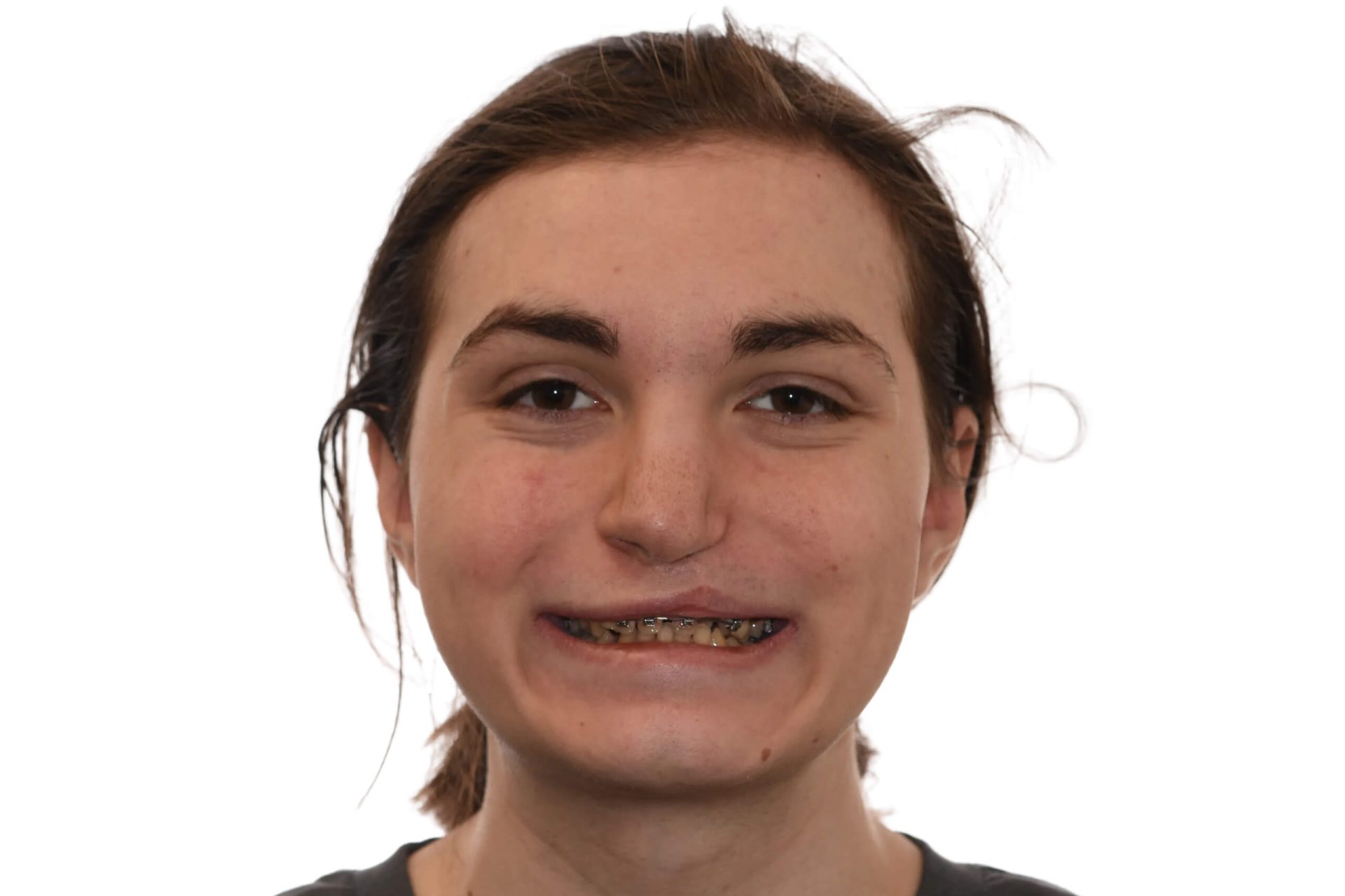 angelo-frontal-after image 2-scaled Frontal View After Surgery of a patient treated with cleft maxillary distraction Surgery at the Jaw Surgery Center of New Jersey.