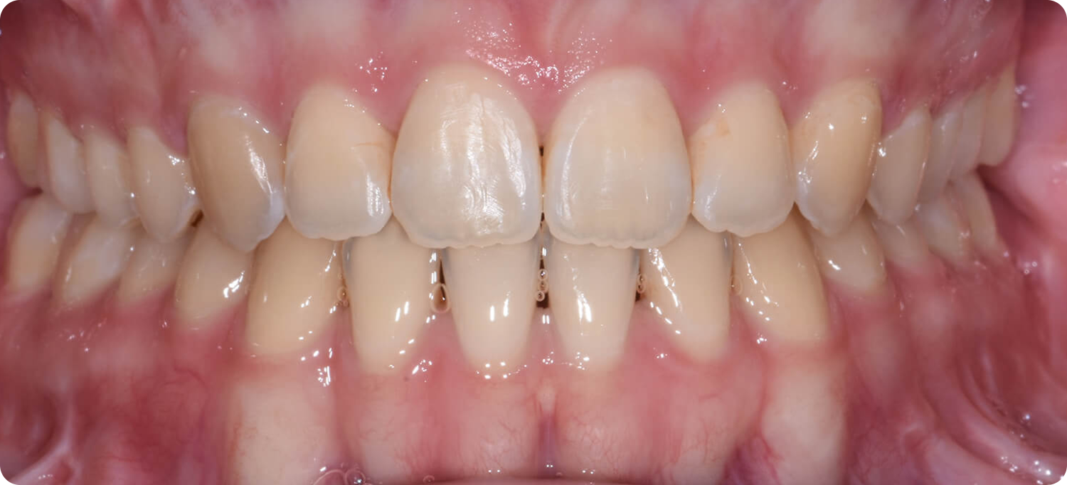 Occlusal View After Surgery of a patient treated with orthognathic surgery for Anterior Open Bite at the Jaw Surgery Center of New Jersey.