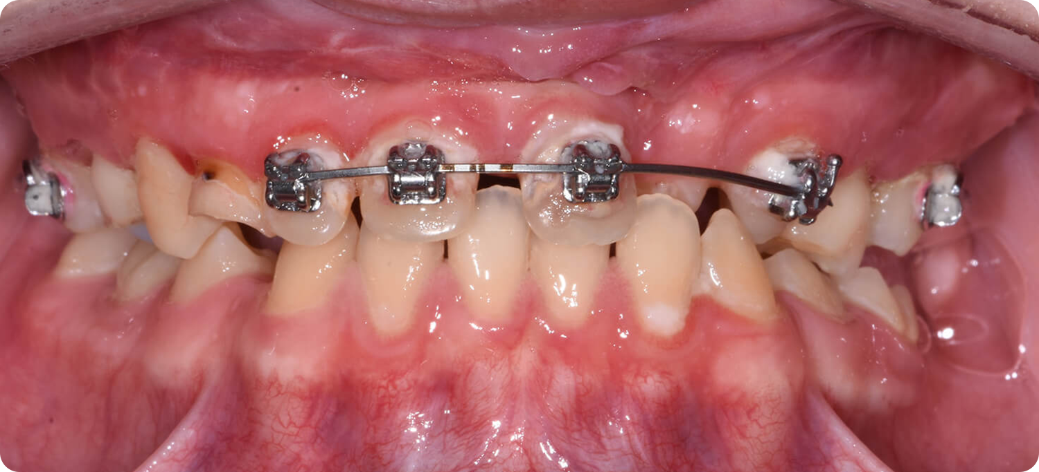 pacifico-occlusal-after-curved Occlusal View After Surgery of a patient treated with Maxillary Distraction at the Jaw Surgery Center of New Jersey.