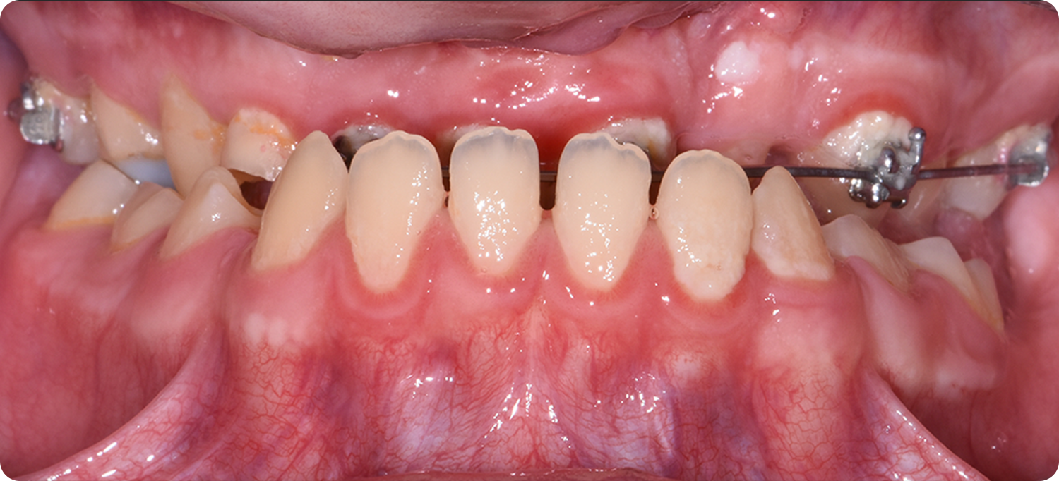 pacifico-occlusion-before-curved Occlusal View Before Surgery of a patient treated with Maxillary Distraction at the Jaw Surgery Center of New Jersey.