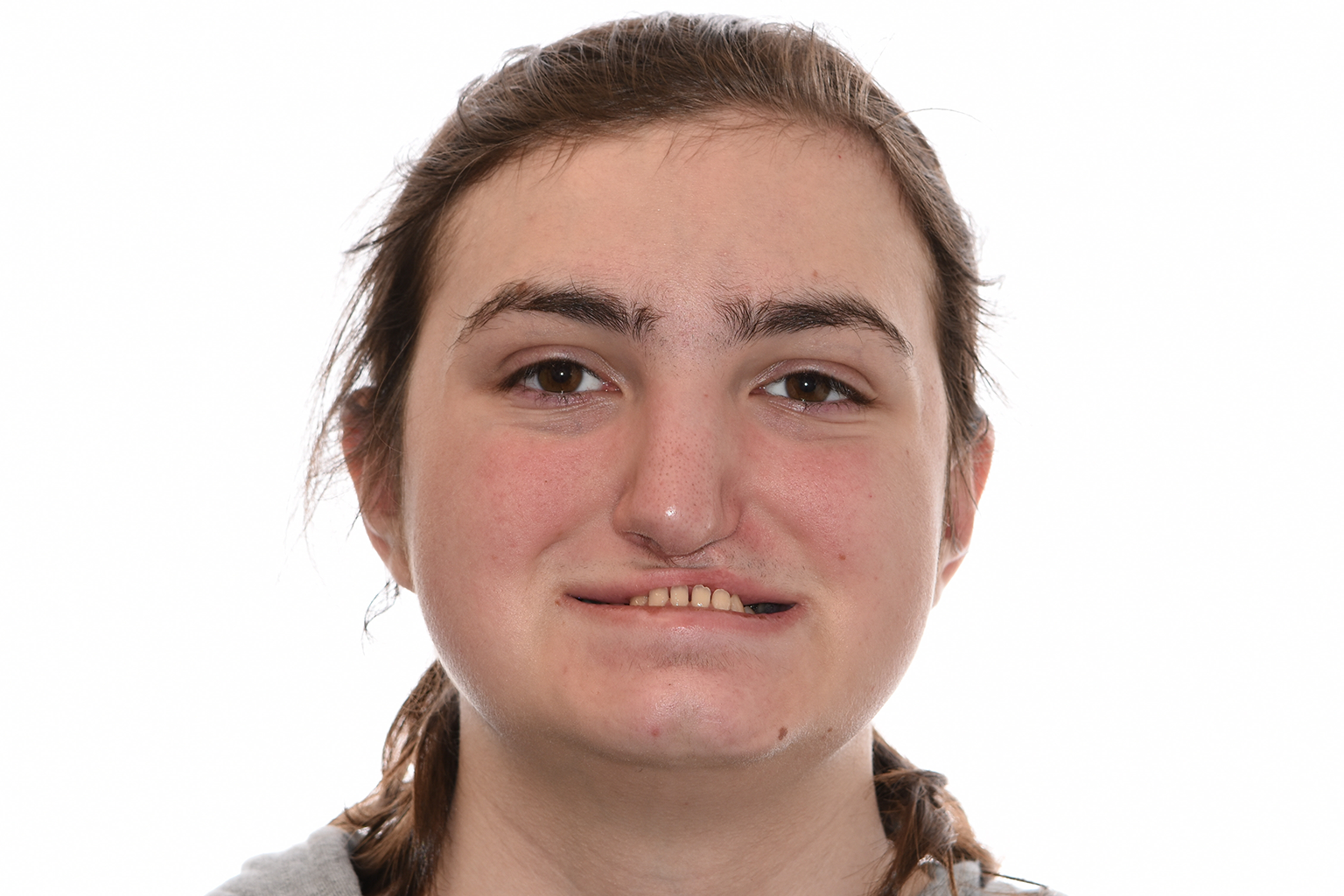 pacifico profile after 3 Profile After Surgery of a patient treated with orthognathic surgery at the Jaw Surgery Center of New Jersey.