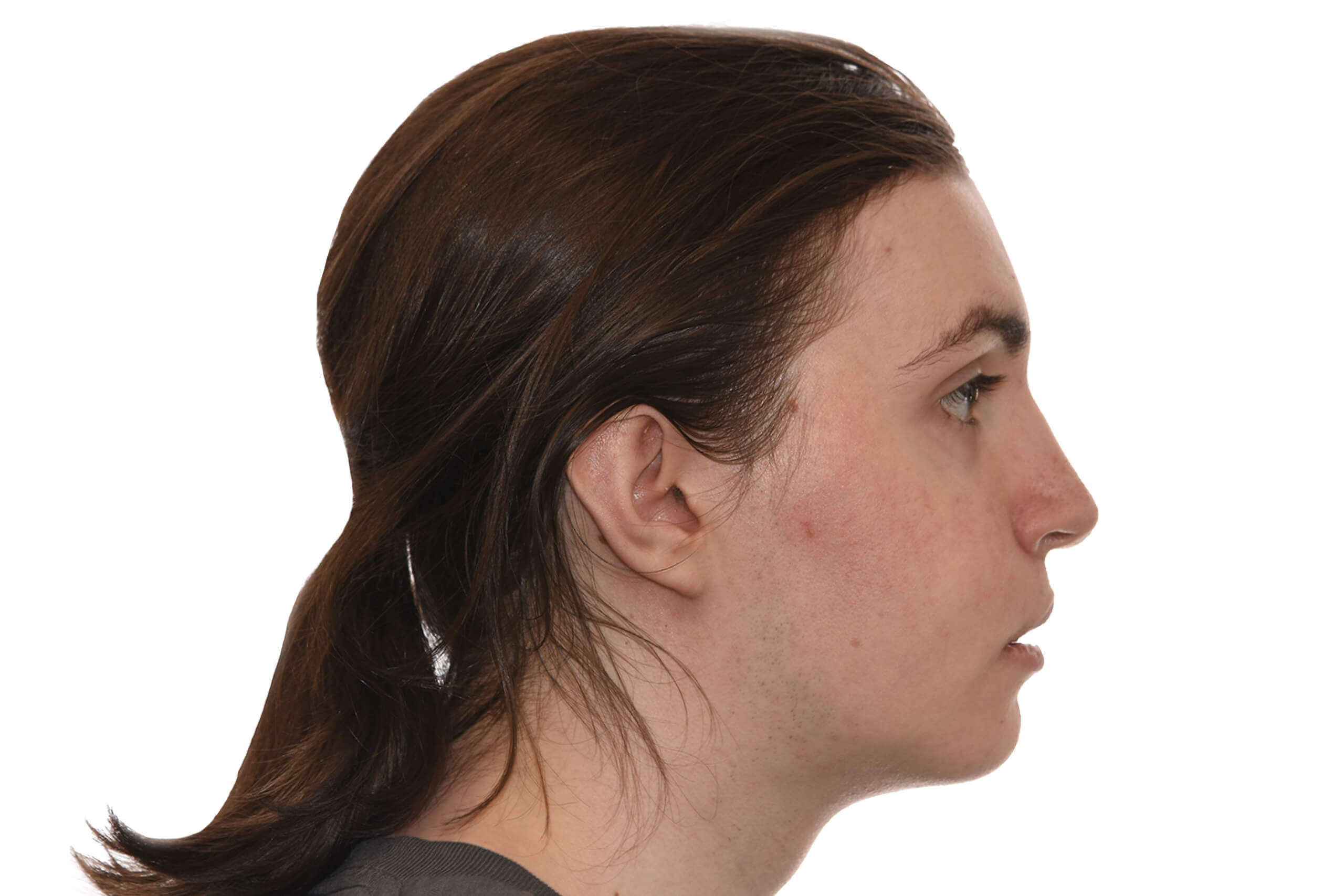 Profile After Surgery of a patient treated with orthognathic surgery at the Jaw Surgery Center of New Jersey.