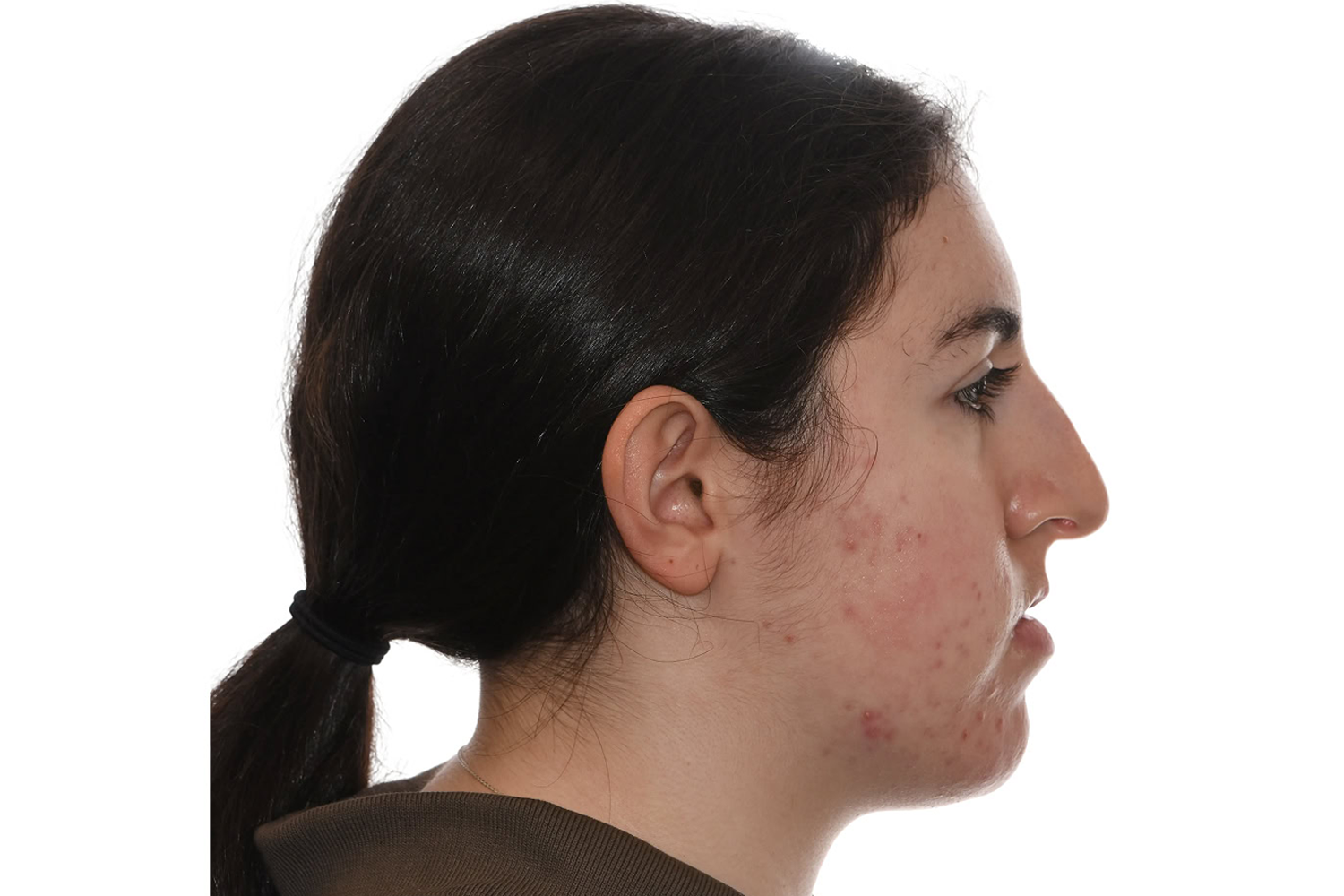 Profile Before Anterior Open Bite Surgery at the Jaw Surgery Center of New Jersey.