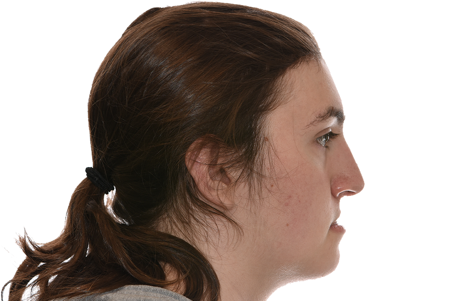 pacifico profile before 3 Profile Before Surgery of a patient treated with orthognathic surgery at the Jaw Surgery Center of New Jersey.
