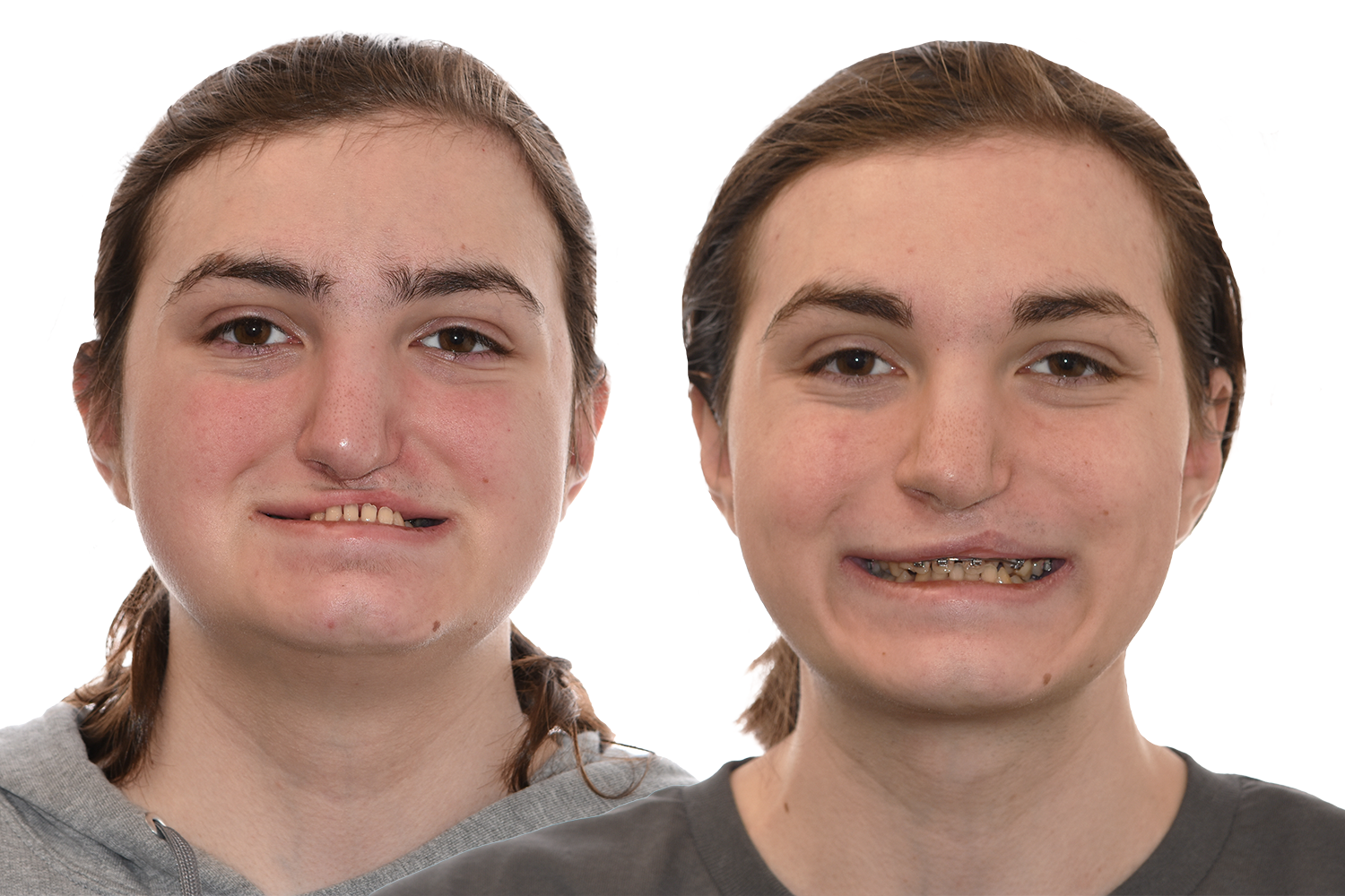 Before and After Comparison of a patient with cleft maxillary hypoplasia treated with orthognathic surgery at the Jaw Surgery Center of New Jersey.