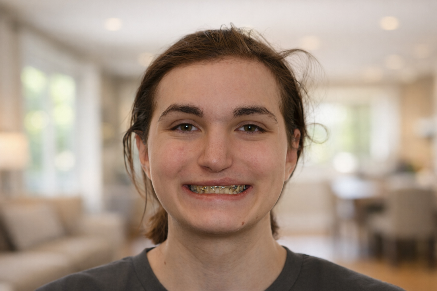 Frontal Result Photo of a patient treated with orthognathic surgery for cleft maxillary hypoplasia at the Jaw Surgery Center of New Jersey.