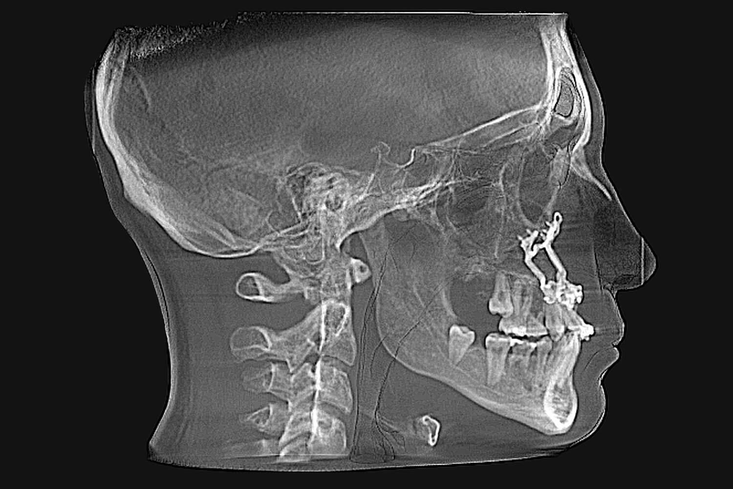 pacifico-after-xray-scaled X-Ray After Surgery of a patient treated with orthognathic surgery at the Jaw Surgery Center of New Jersey.