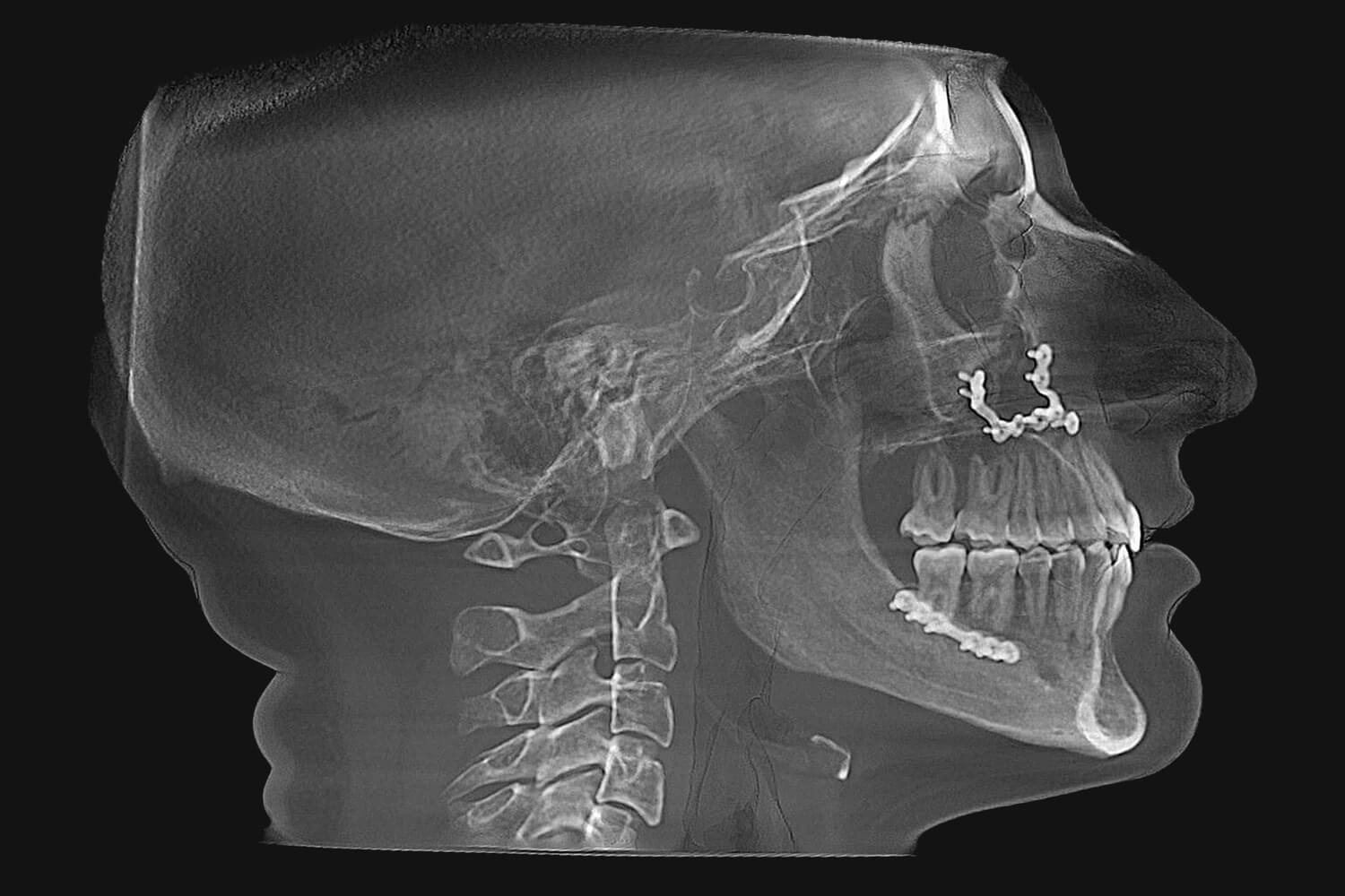 klee-after-xray X-Ray After Surgery of a patient treated with orthognathic surgery at the Jaw Surgery Center of New Jersey.
