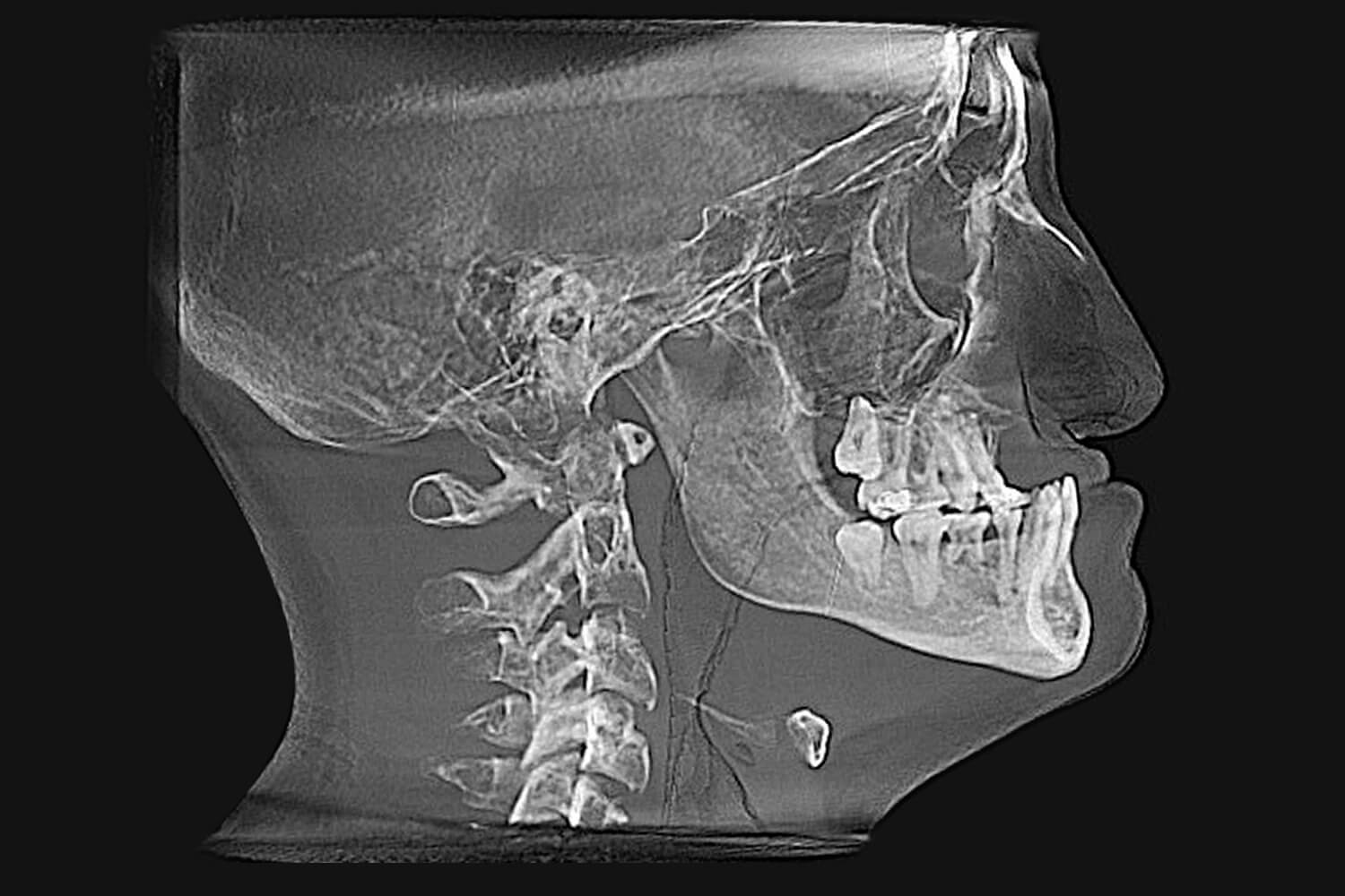 pacifico-before-xray-scaled X-Ray Before Surgery of a patient treated with orthognathic surgery at the Jaw Surgery Center of New Jersey.