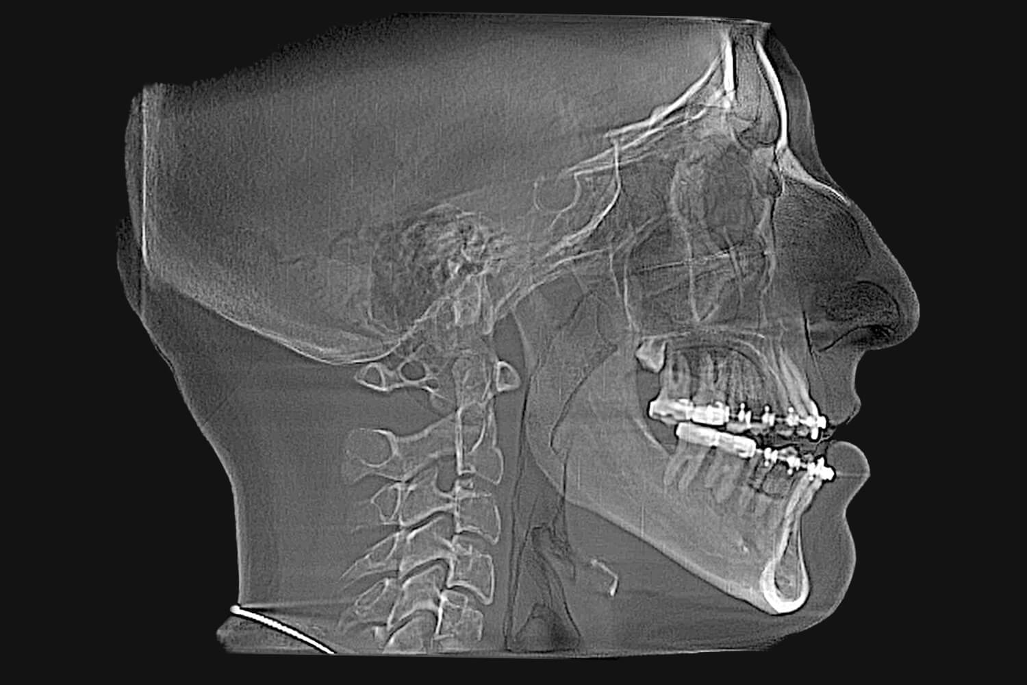 klee-before-xray X-Ray Before Surgery of a patient treated with orthognathic surgery at the Jaw Surgery Center of New Jersey.