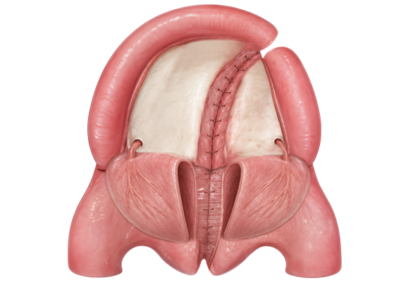 bardach 5 - reframed - wide Illustration of the palatal flaps brought together and sutured at the midline in Bardach palatoplasty.