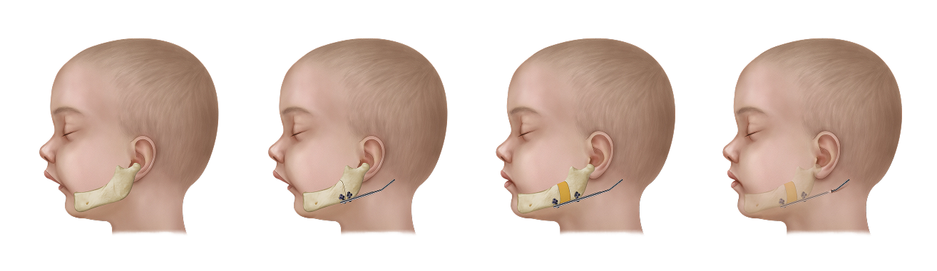 Distraction-Pediatric Mandibular Distraction Pediatric mandibular distraction illustration