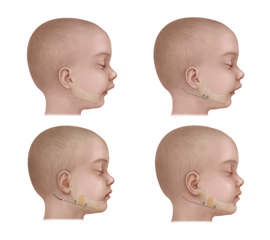 Illustration of mandibular distraction gradually lengthening an infant lower jaw.