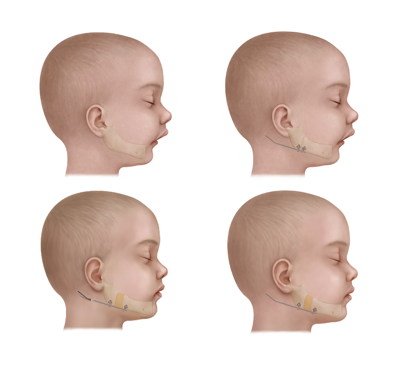 Illustration of pediatric mandibular distraction lengthening the lower jaw in a child.