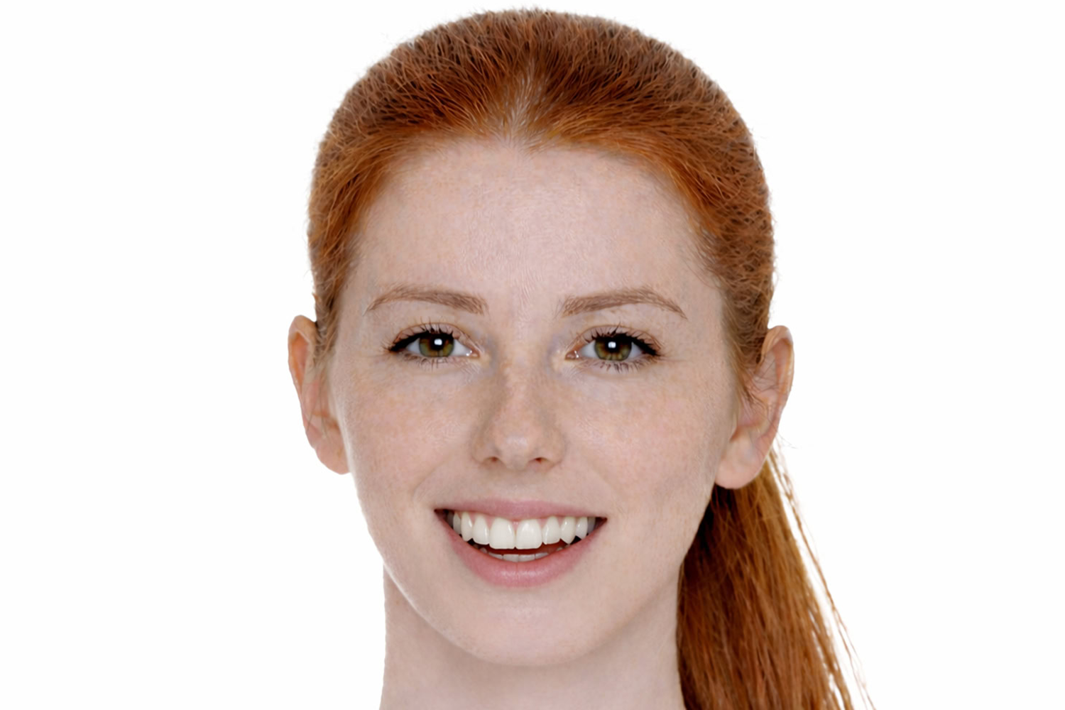 mandibular-retrognathia-front-3 Close-up of a smiling woman with red hair and clear skin with retrognathia.