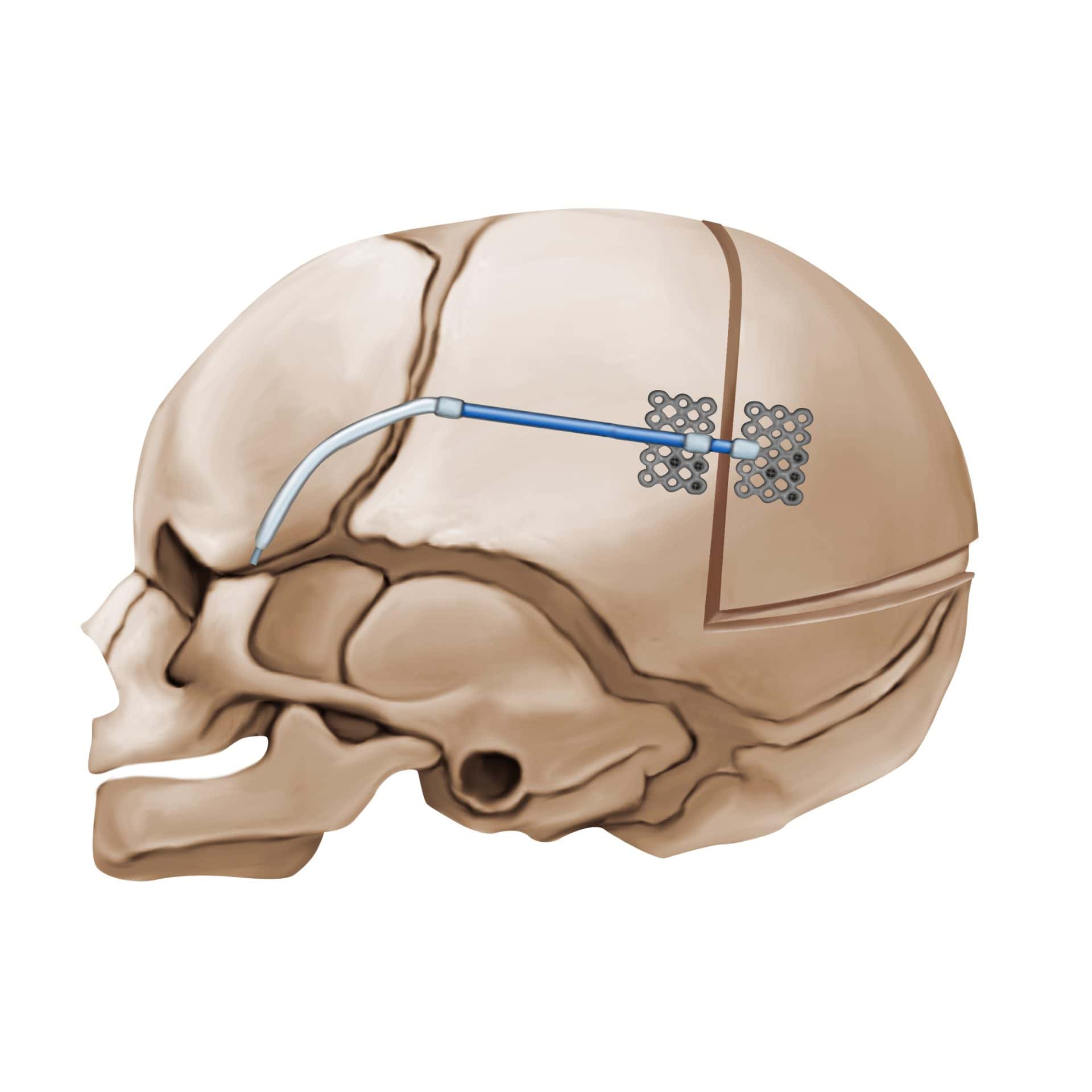 Illustration of posterior cranial vault distraction.