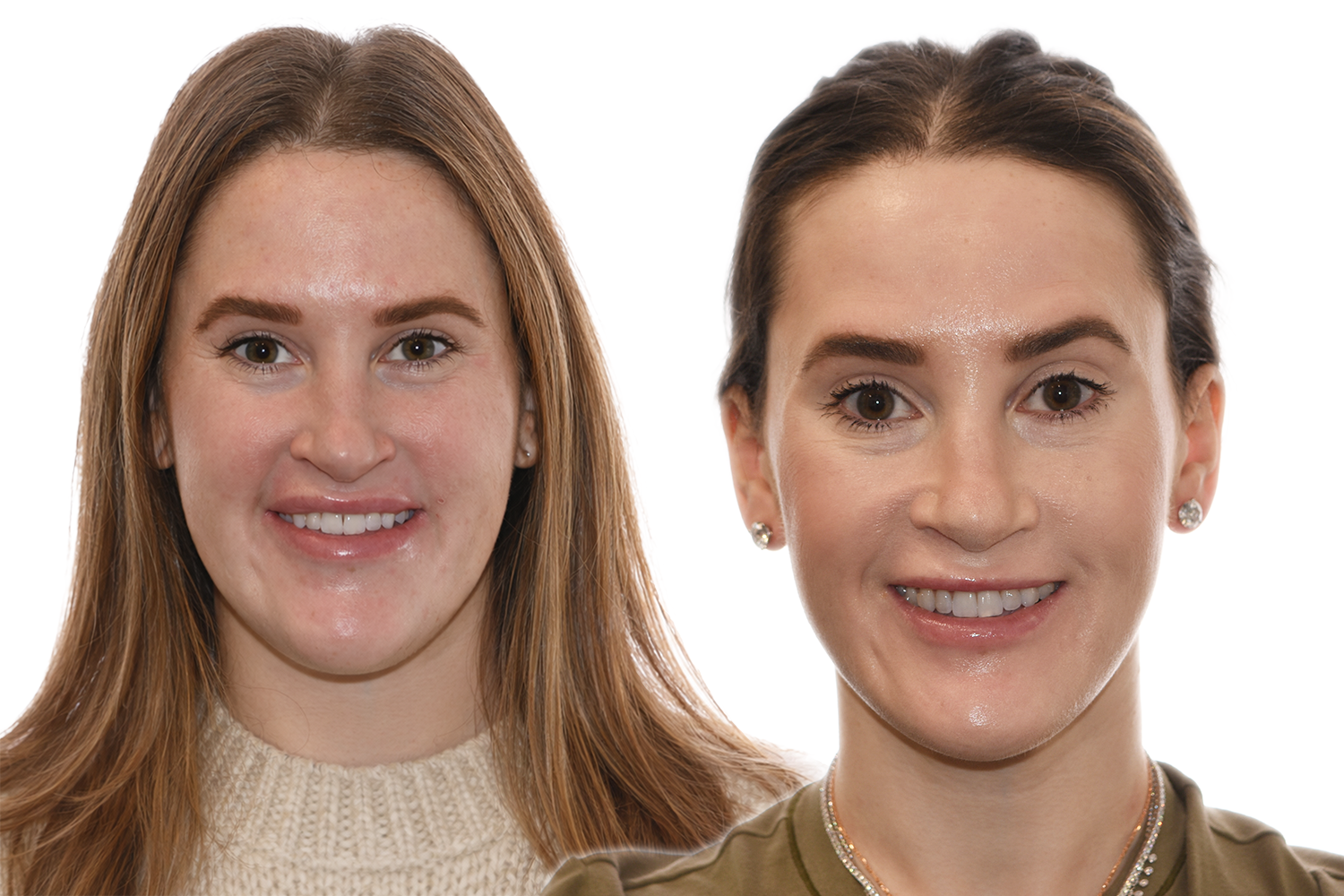 Before and After Comparison of a patient treated with prognathism correction at the Jaw Surgery Center of New Jersey.